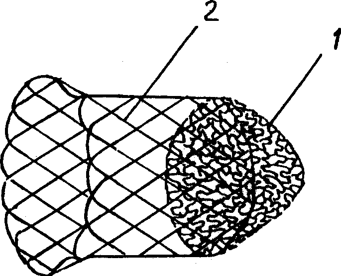 Implantation type thrombus filter