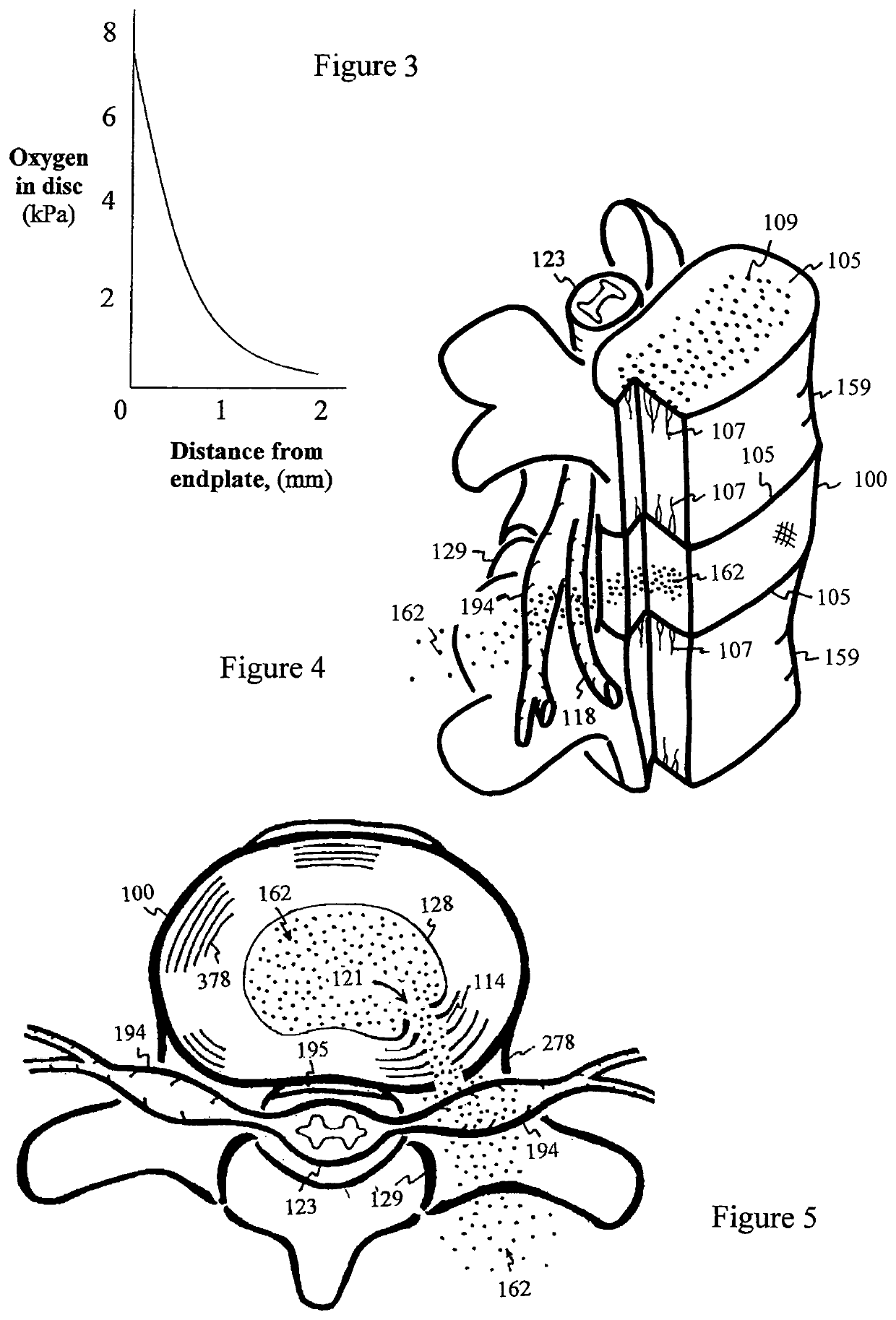 Method for relieving pain and regenerating intervertebral disc