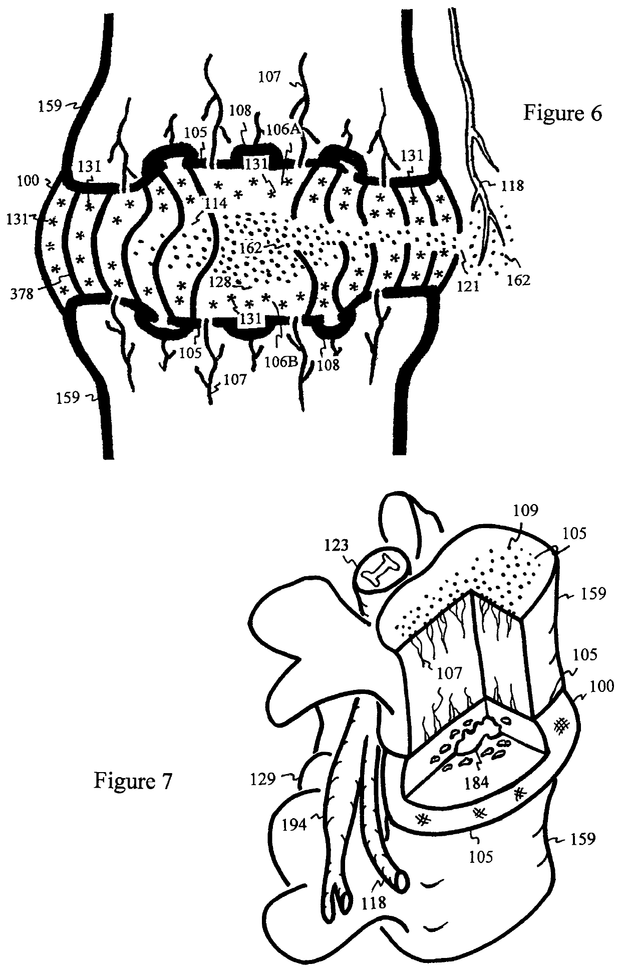 Method for relieving pain and regenerating intervertebral disc