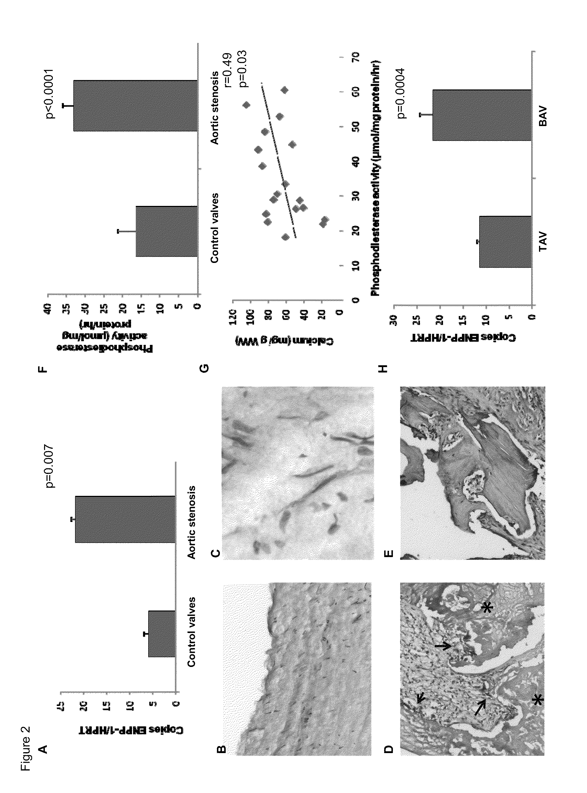 Ectonucleotidase pyrophosphate/phosphodiesterase-1 (enpp-1) as a target for the treatment of aortic valve stenosis and cardiovascular calcification