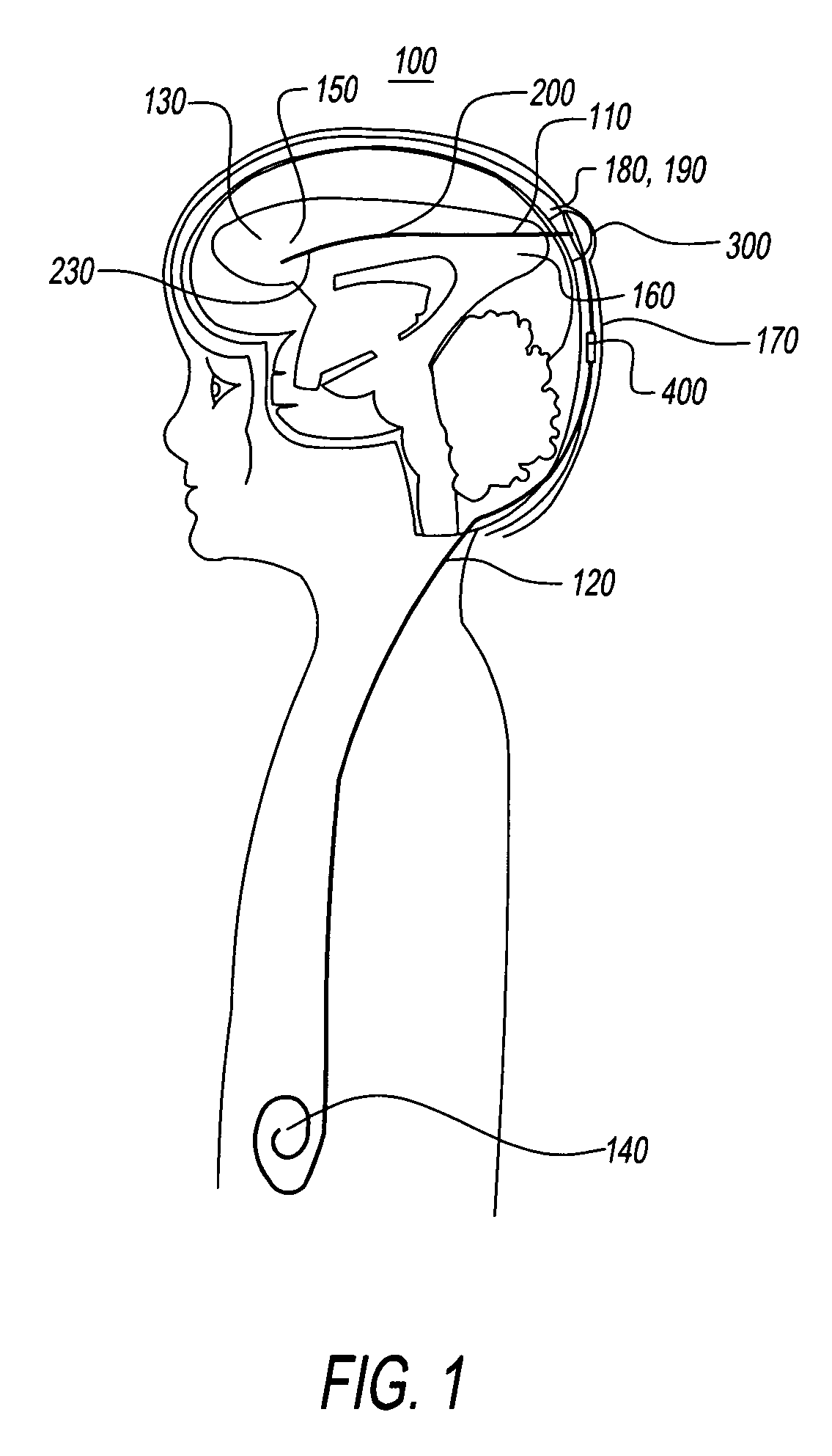 No clog shunt using a compact fluid drag path