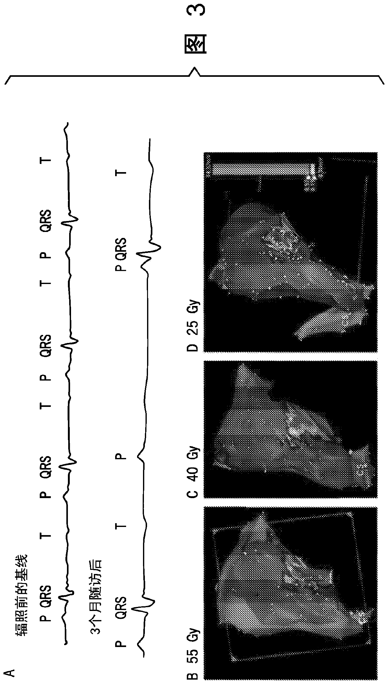 System and method for carbon particle therapy for treatment of cardiac arrhythmias and other diseases