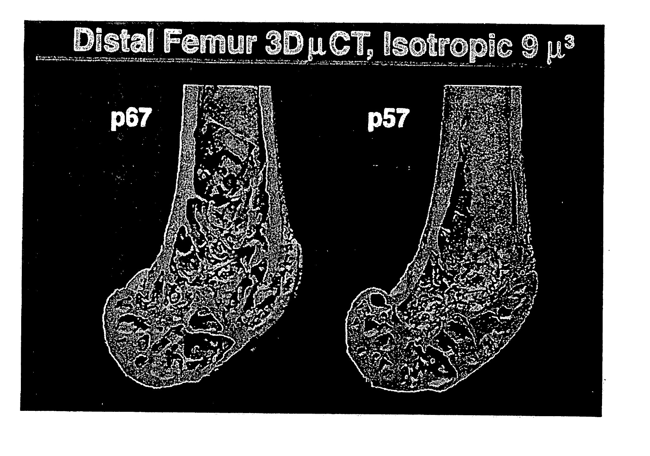 Pthrp-based prediction and diagnosis of bone disease