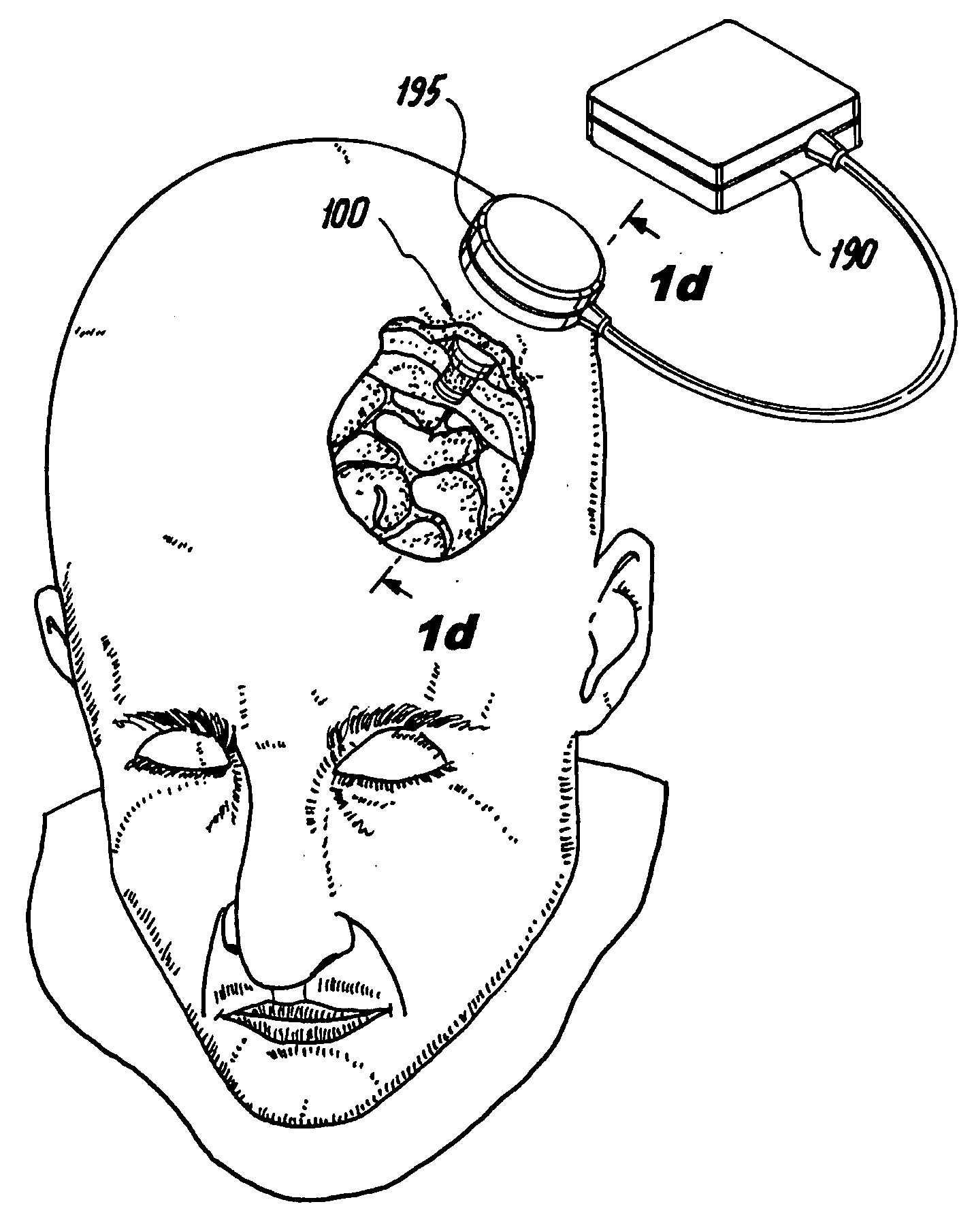 Implantable neurostimulation systems