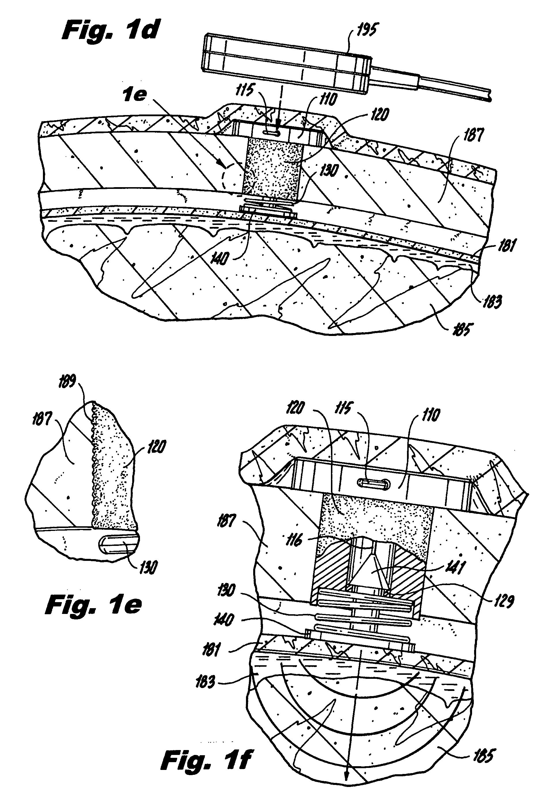 Implantable neurostimulation systems