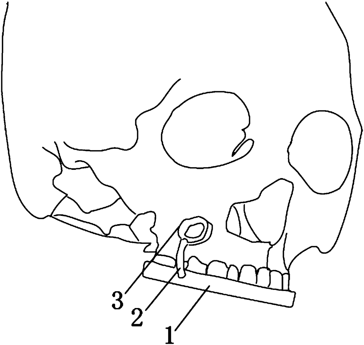 Upper jaw embedded tooth buccal side admission passage pullout guide plate and manufacturing method thereof