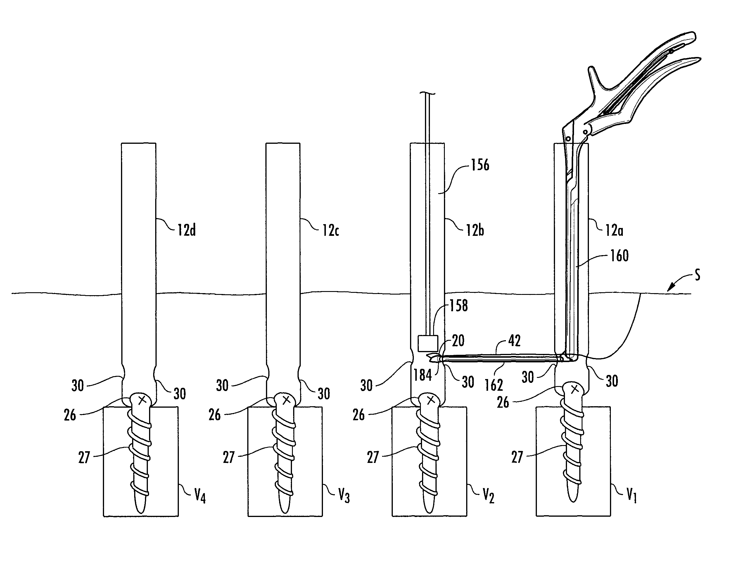 Method and apparatus for facilitating navigation of an implant