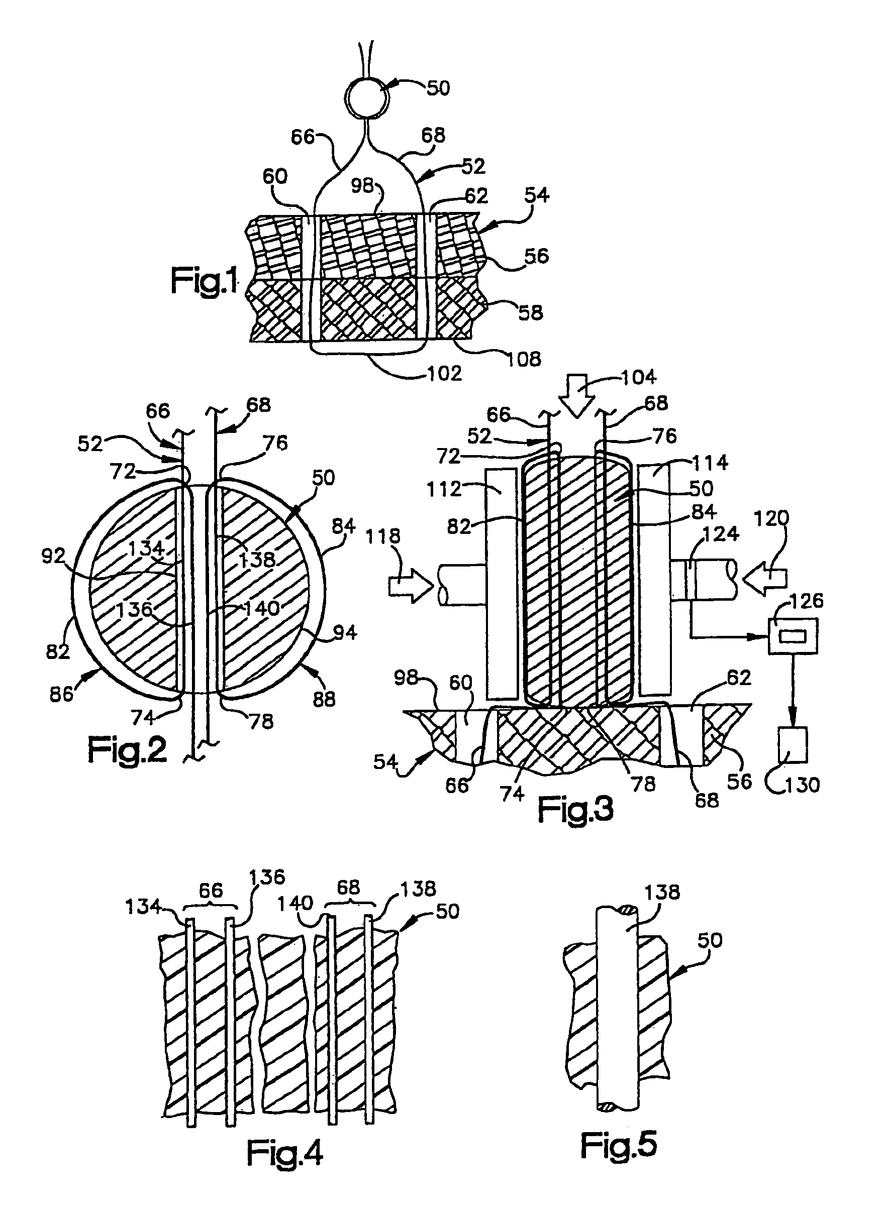 Method for implanting a flowable fastener