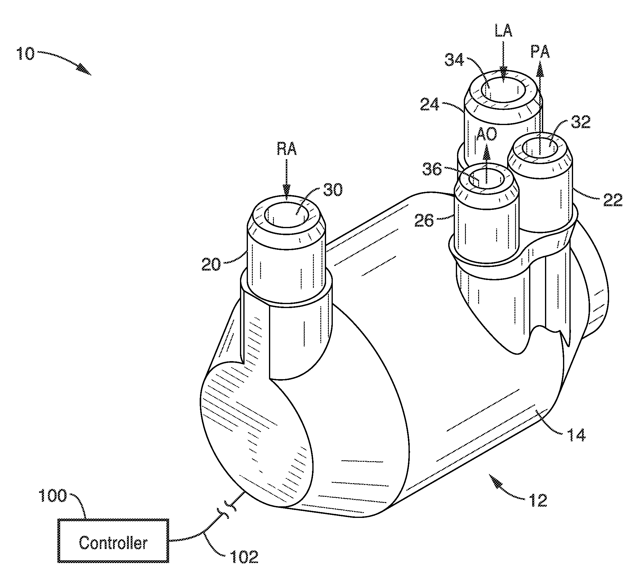 Total artificial heart