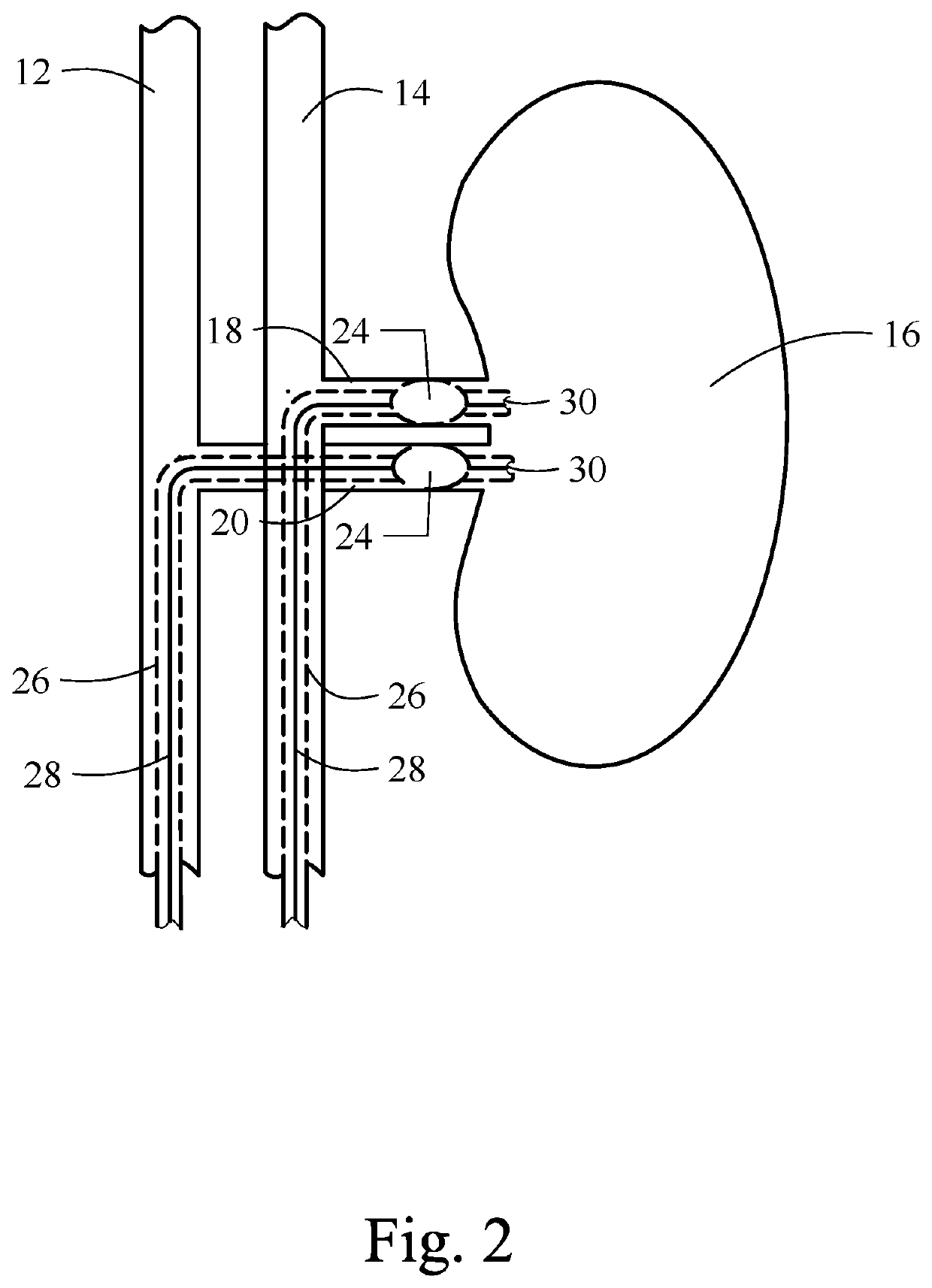 Method for preventing contrast induced nephropathy