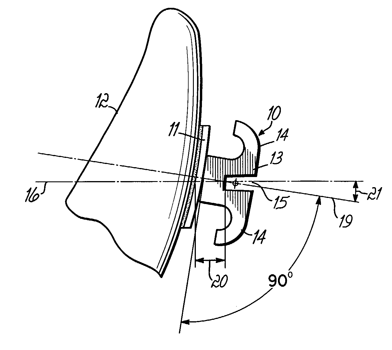 Providing custom orthodontic treatment with appliance components from inventory