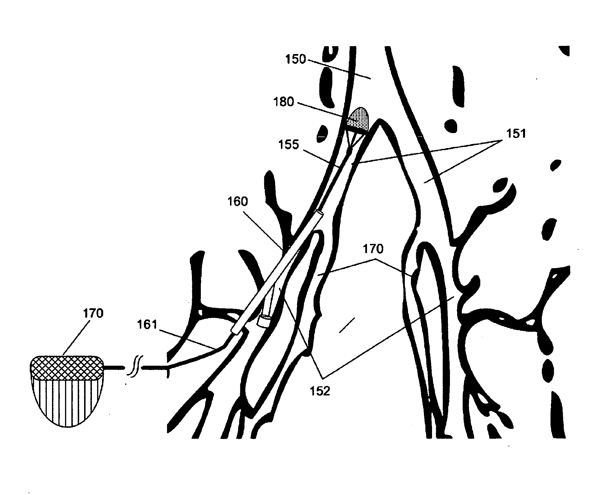 Electrostatic vascular filters