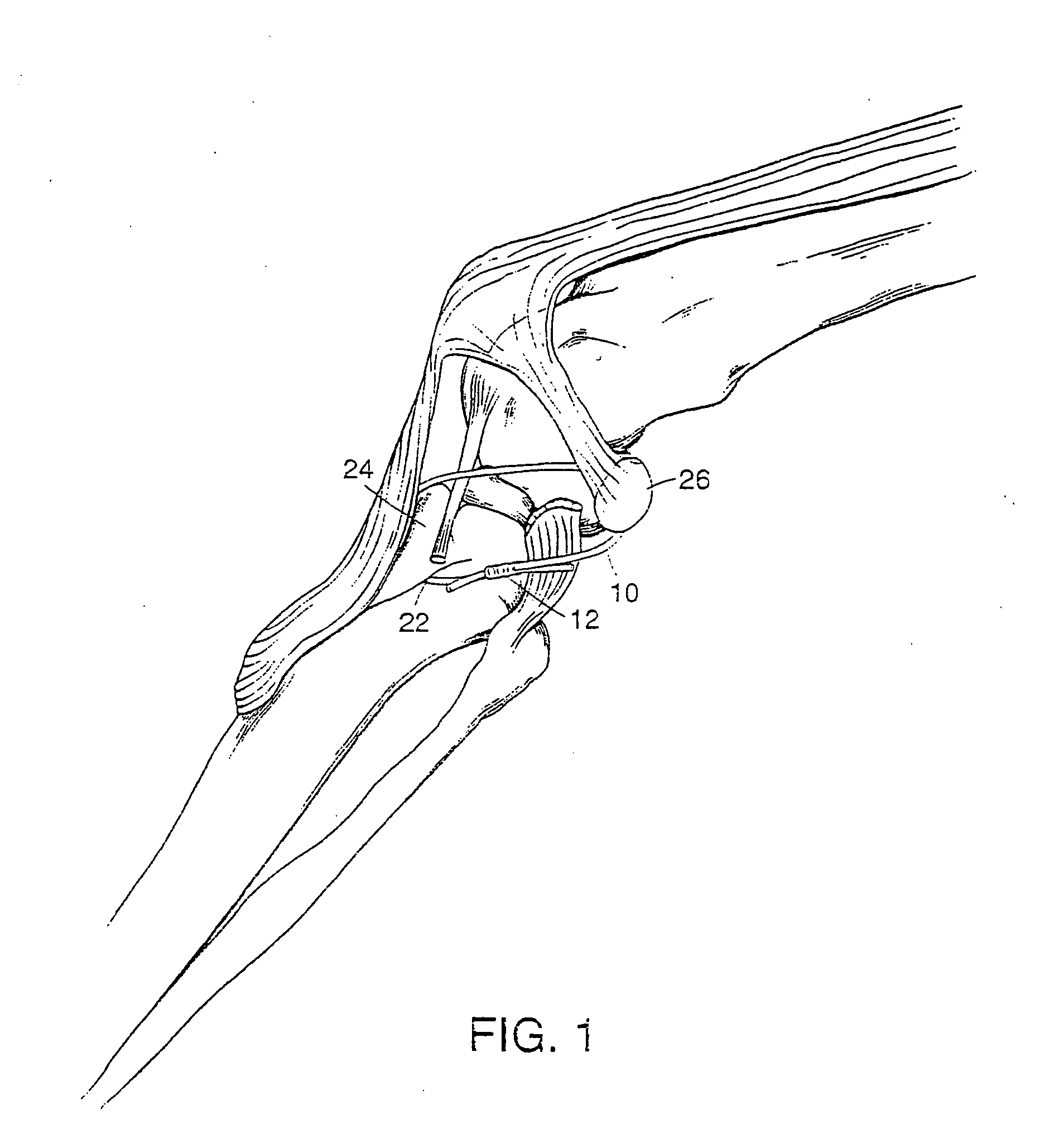 Crimping device for cranial cruciate ligament stabilization