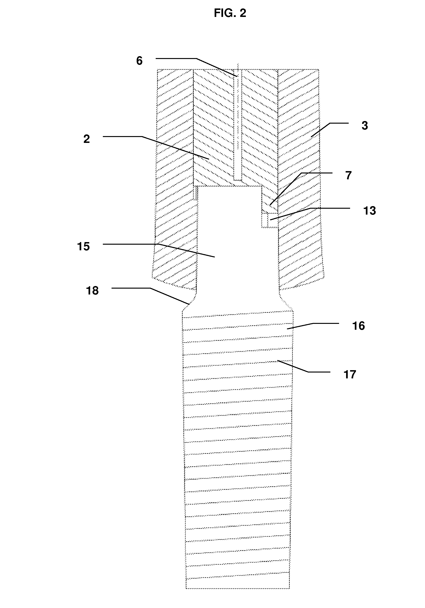 Dental Implant System and Method