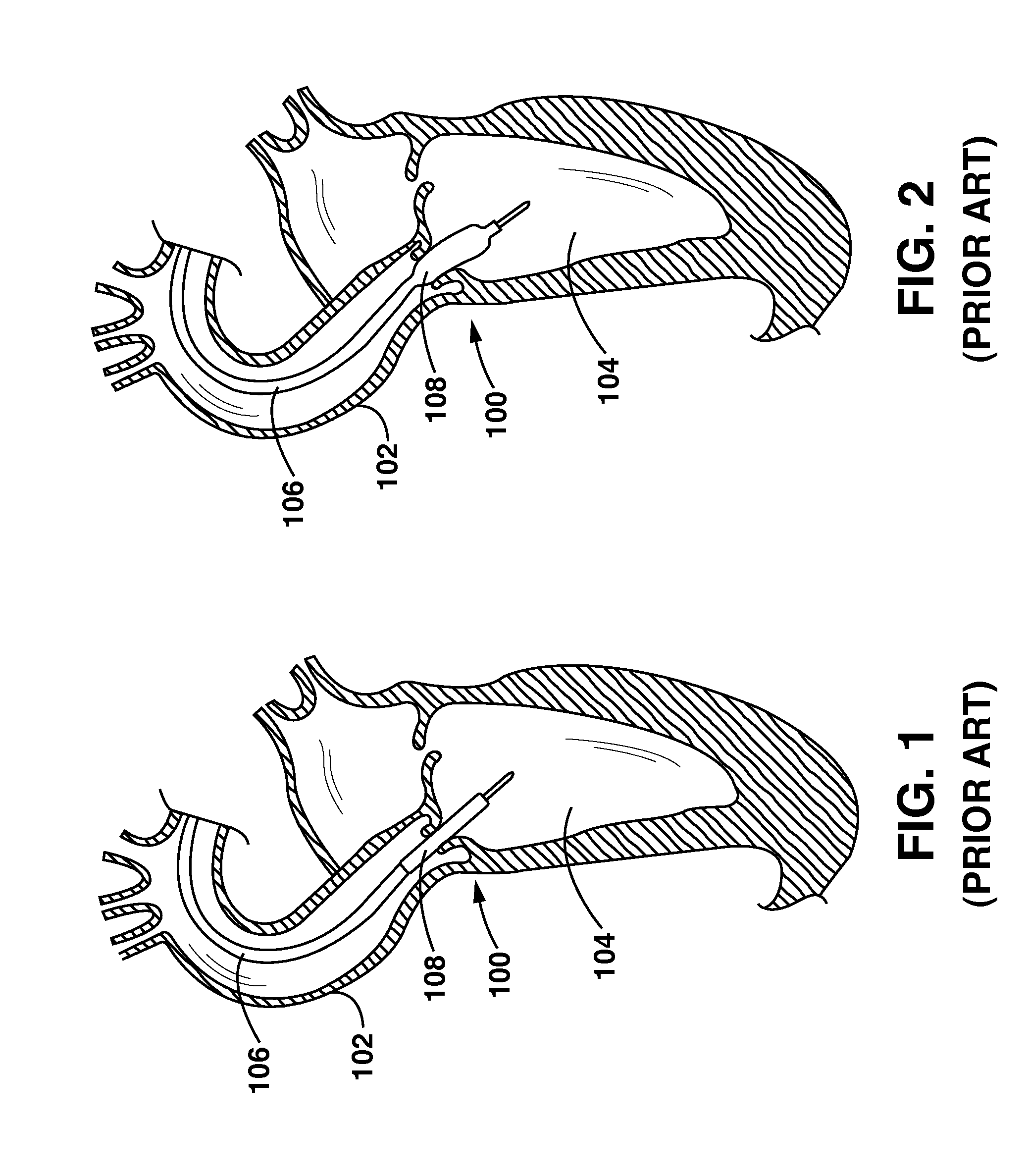 Spiral perfusion dilatation balloon for use in valvuloplasty procedure