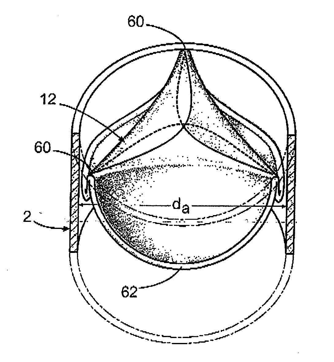 Prosthetic tissue valve