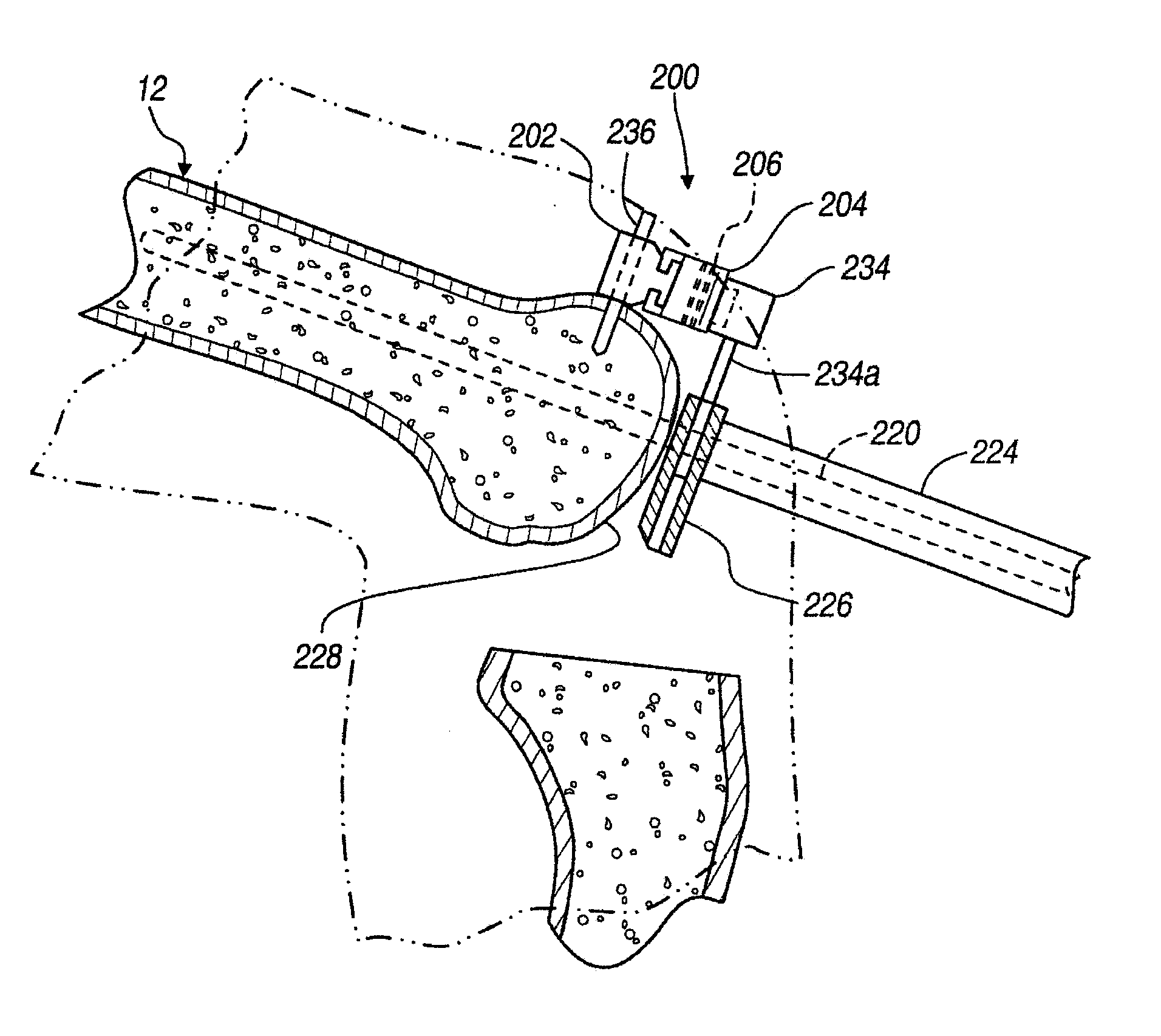 Method and apparatus for less invasive knee resection