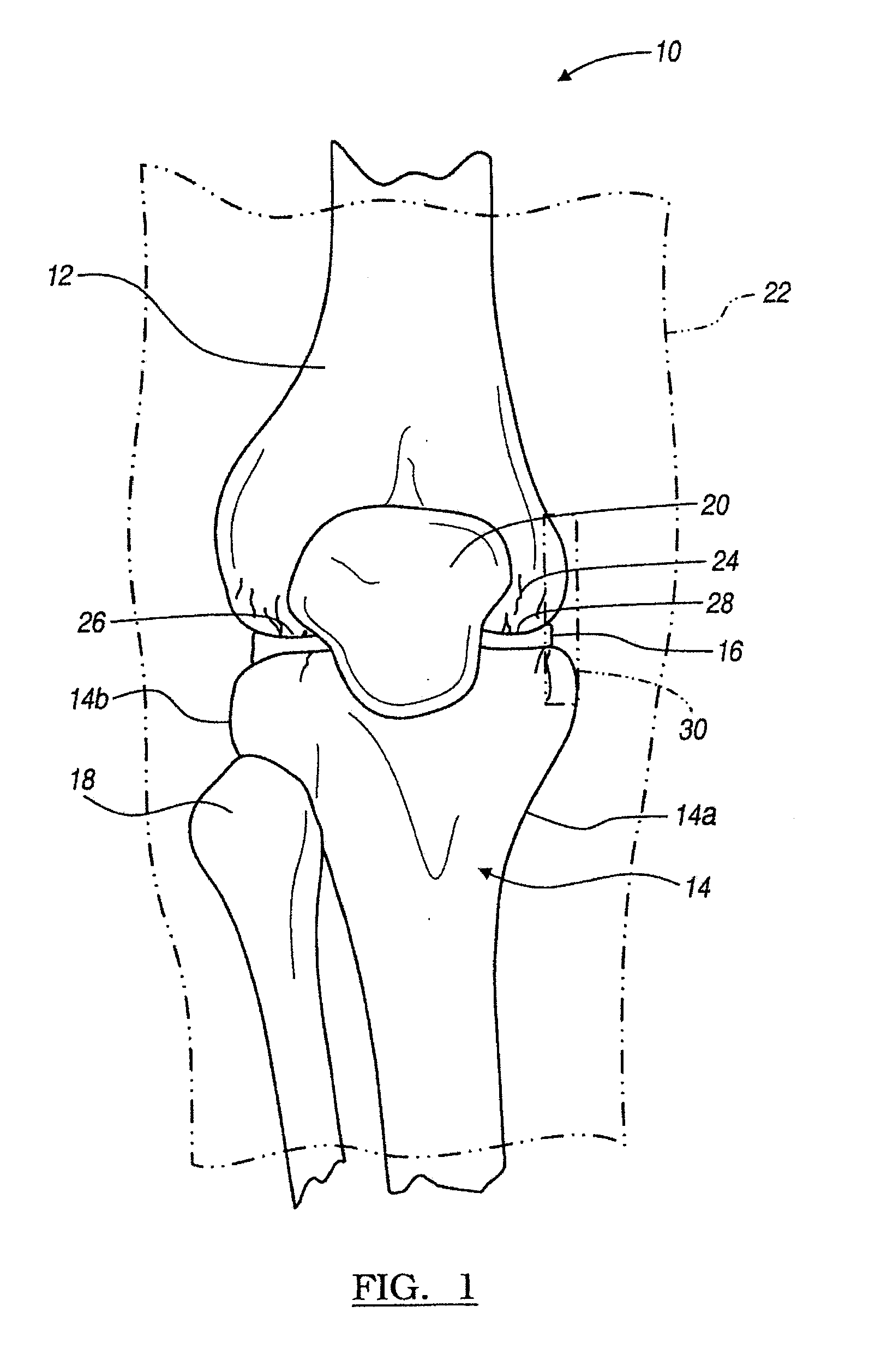 Method and apparatus for less invasive knee resection