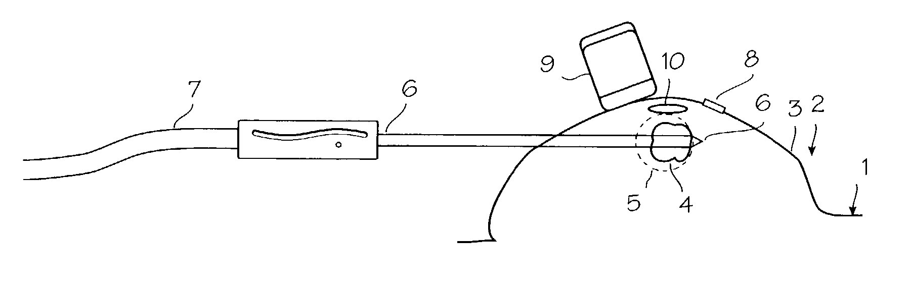 Method and system for cryoablating fibroadenomas