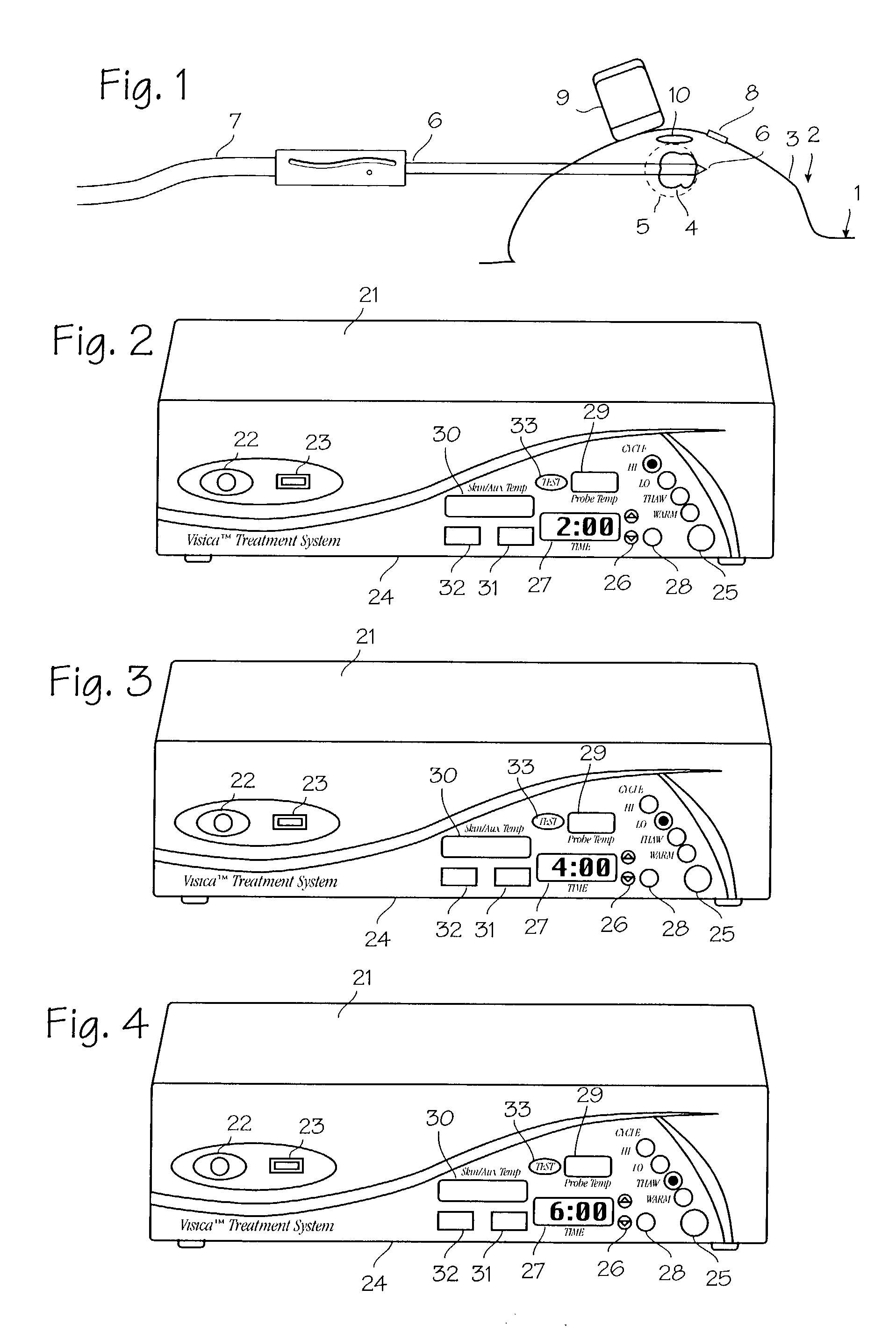 Method and system for cryoablating fibroadenomas