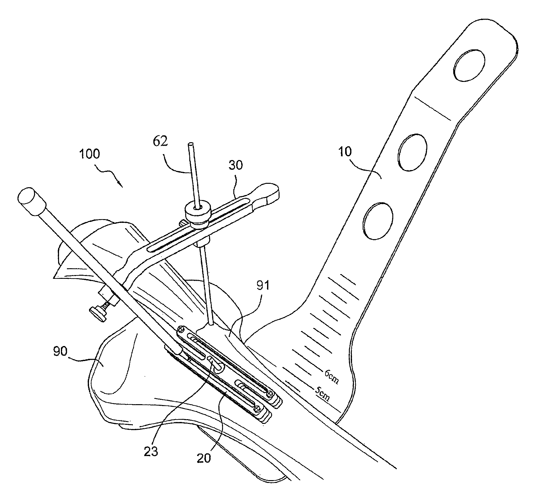 AMZ tibial tuberosity transfer system