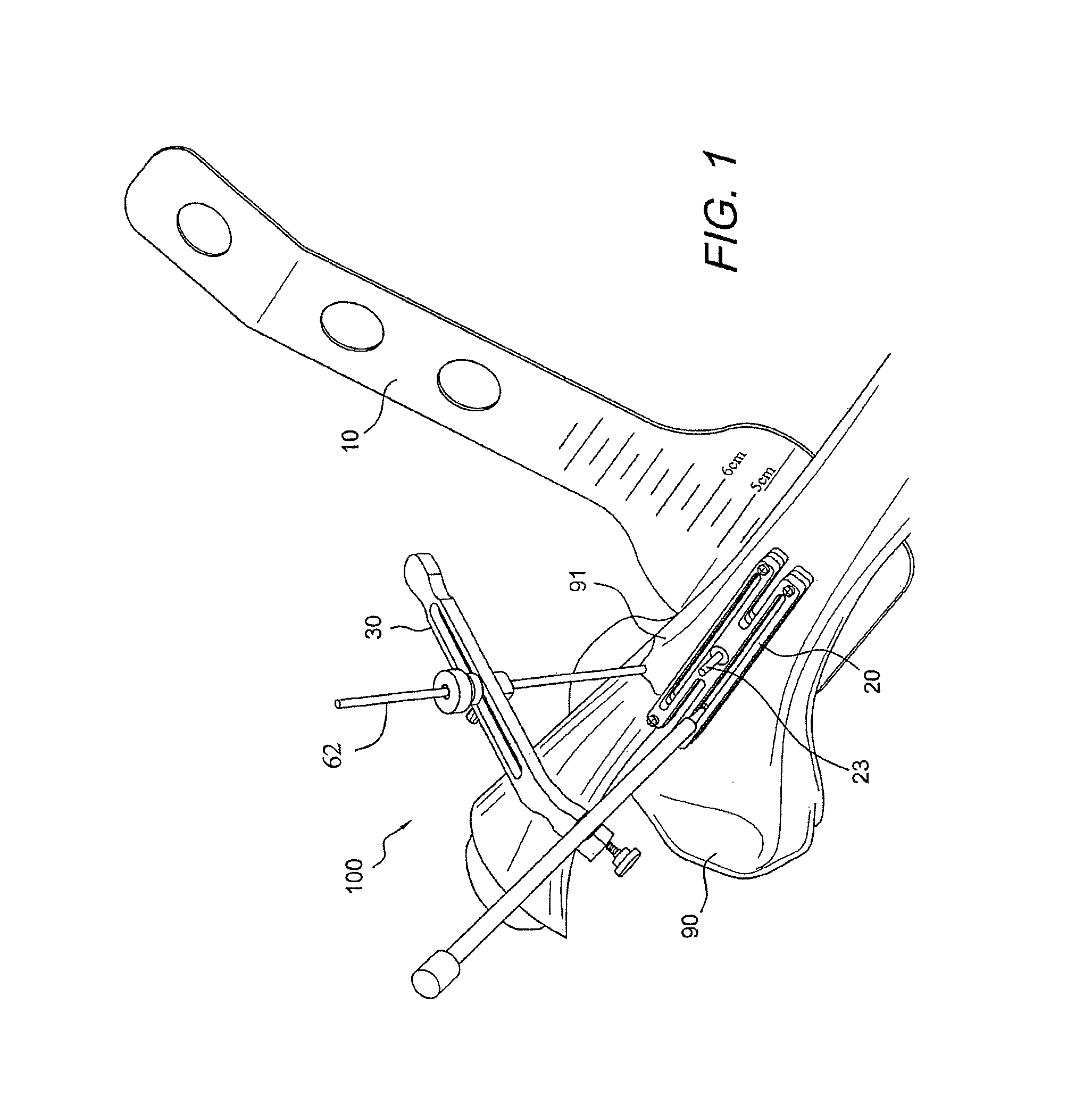 AMZ tibial tuberosity transfer system