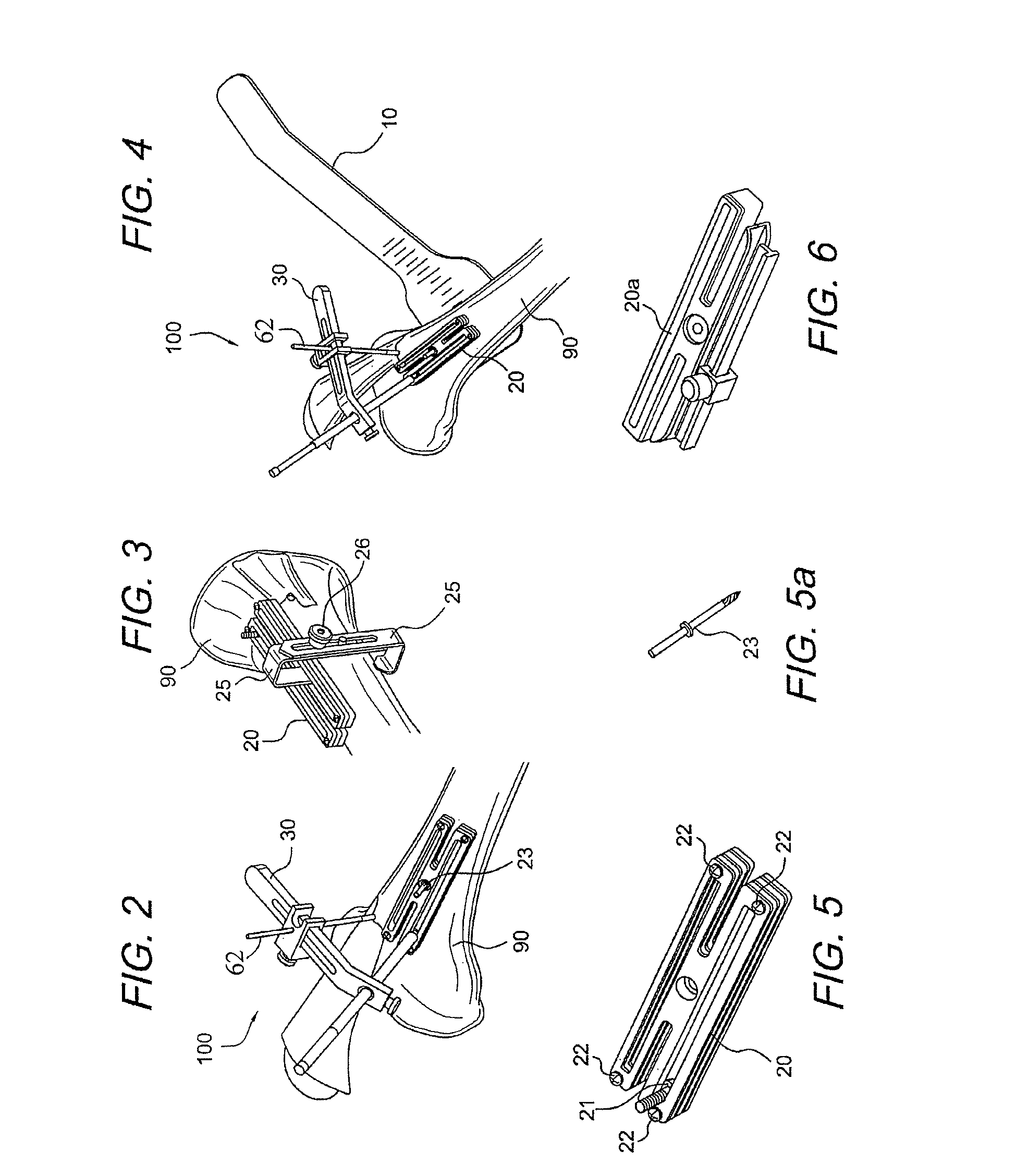 AMZ tibial tuberosity transfer system