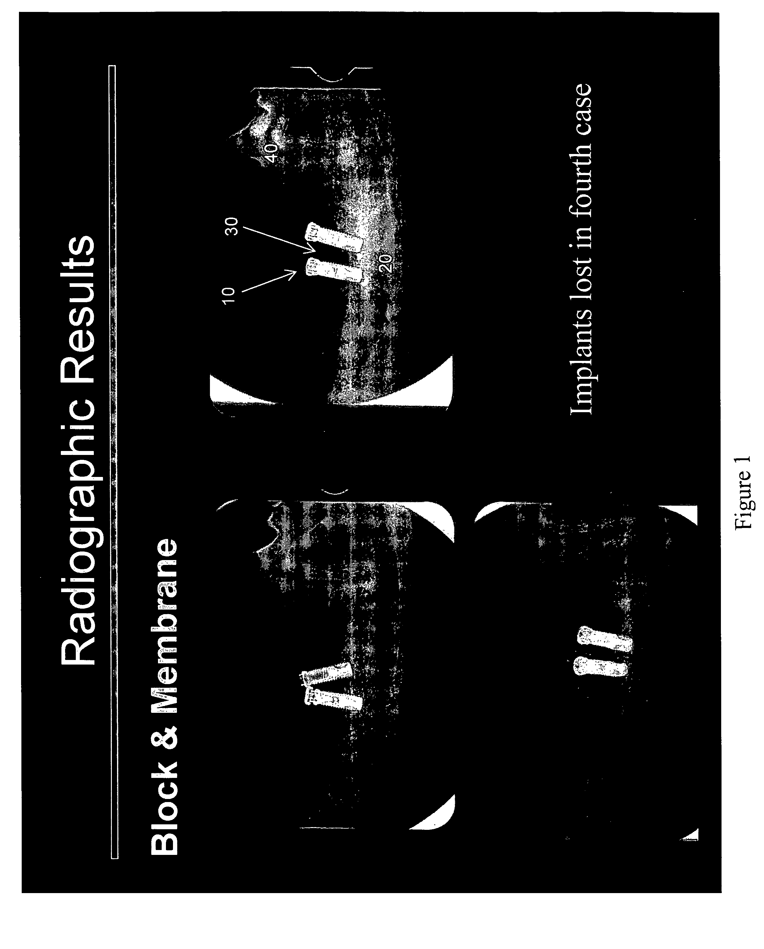 Maxillofacial bone augmentation using rhPDGF-BB and a biocompatible matrix