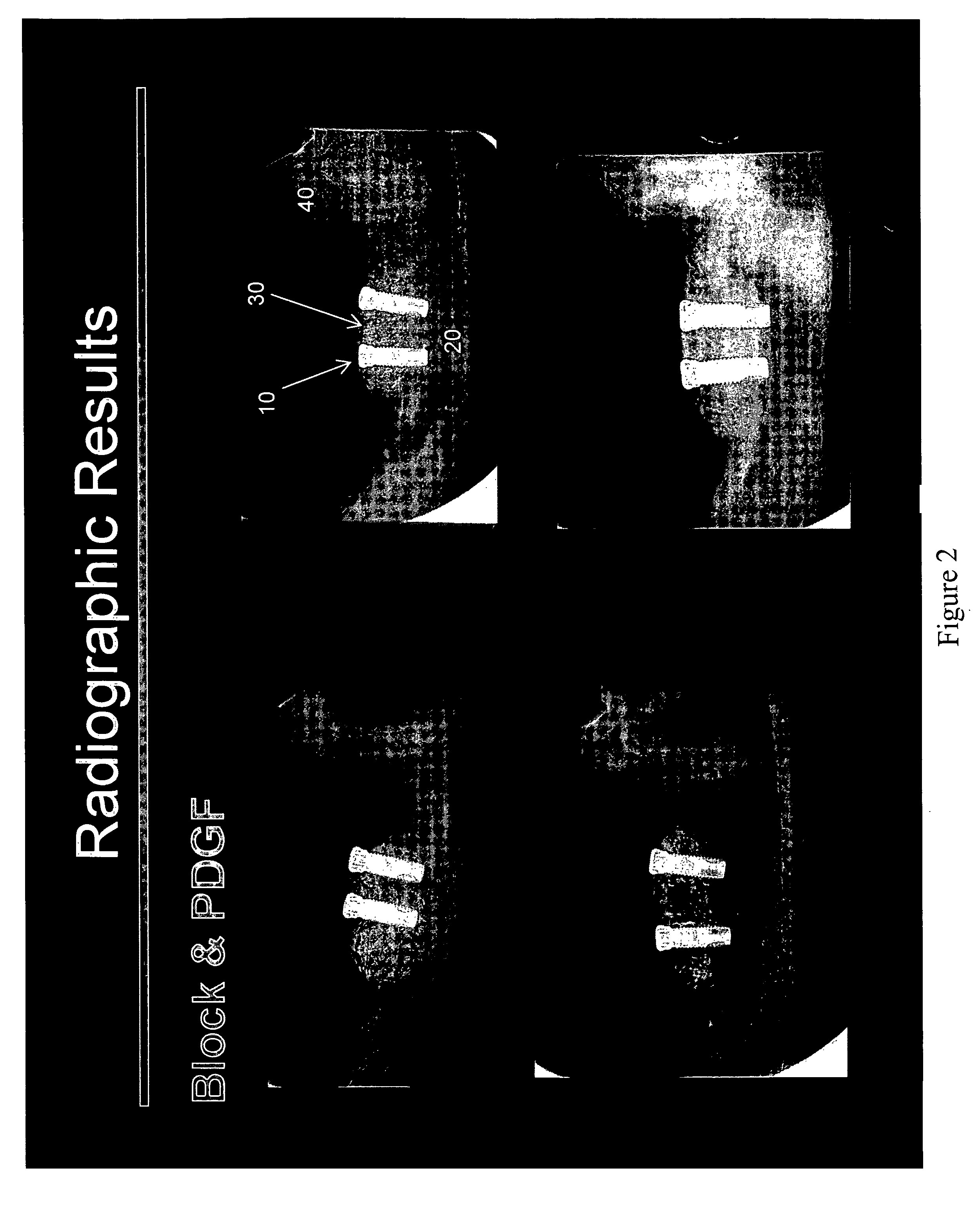 Maxillofacial bone augmentation using rhPDGF-BB and a biocompatible matrix