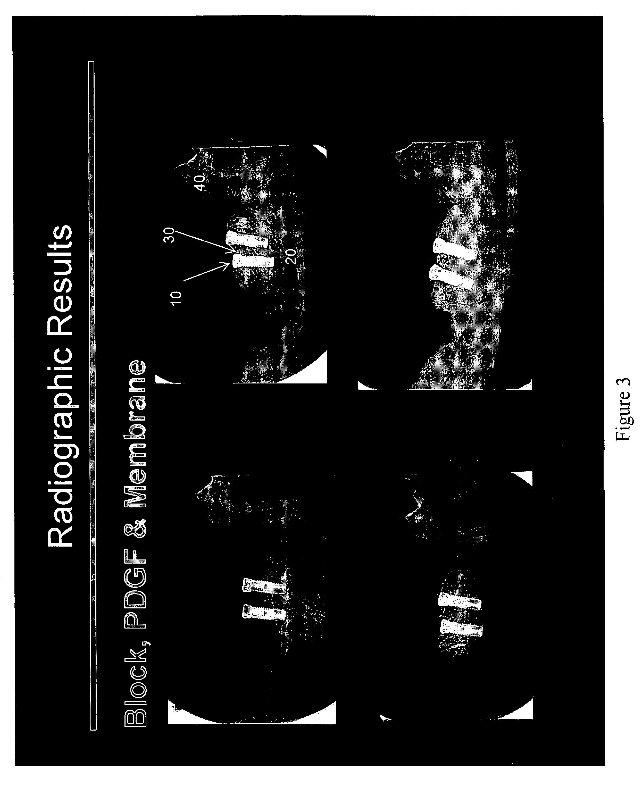 Maxillofacial bone augmentation using rhPDGF-BB and a biocompatible matrix