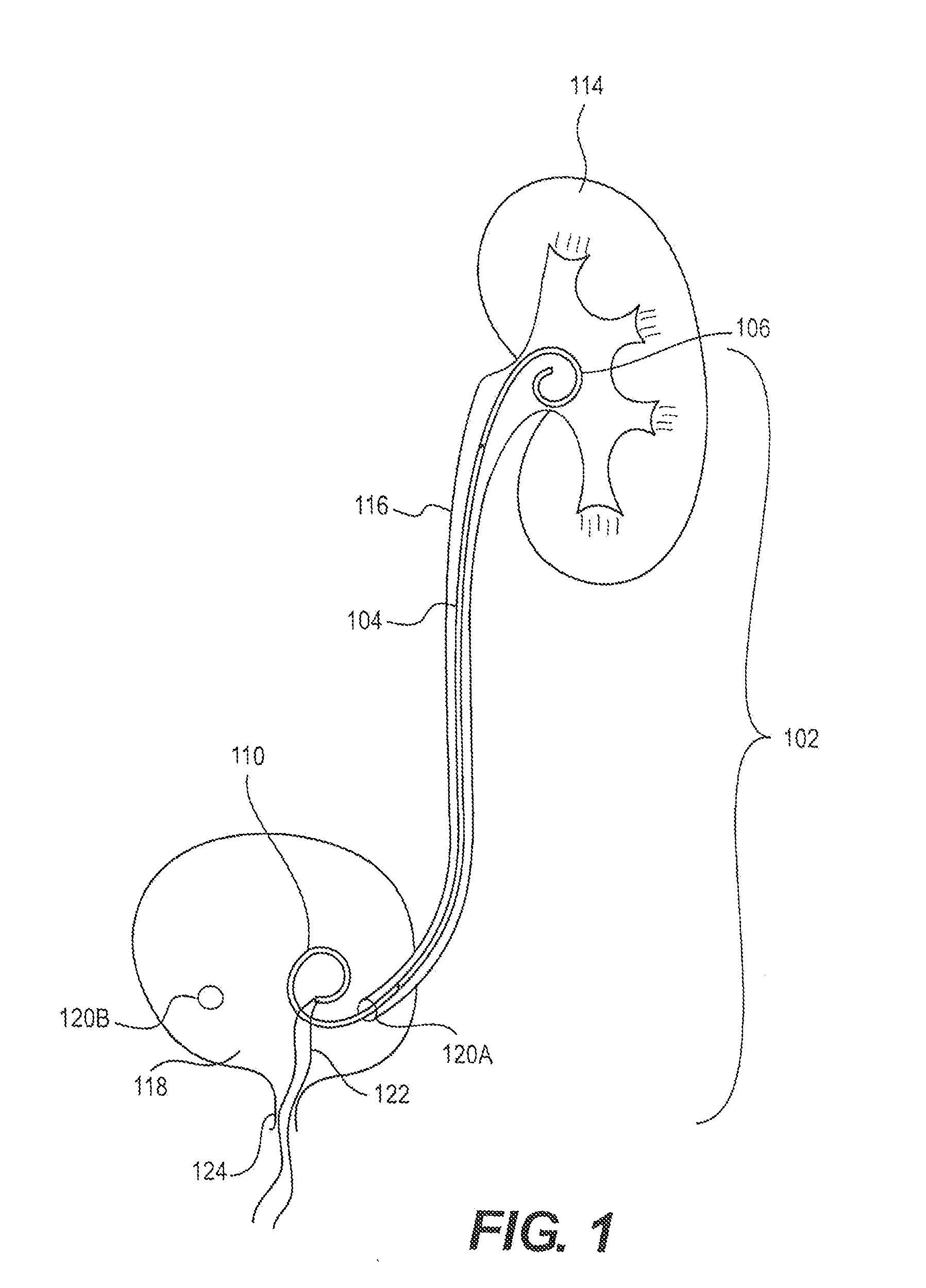 Stents and methods of use thereof