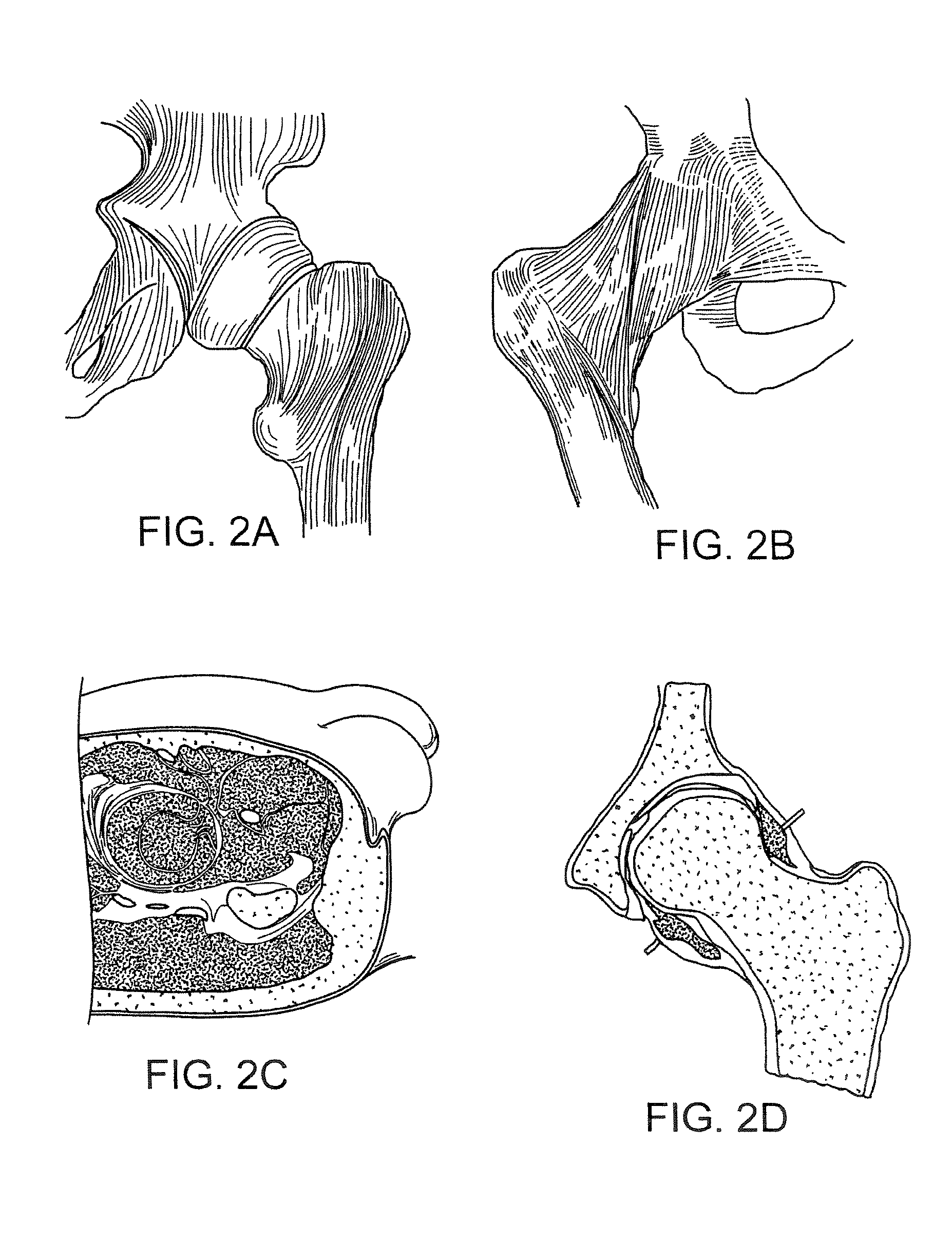 Method and devices for minimally invasive arthroscopic procedures