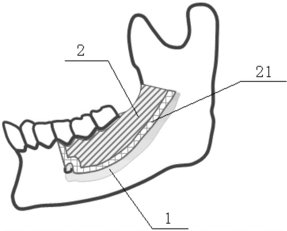 Nerve protection guide plate for mandible osteotomy