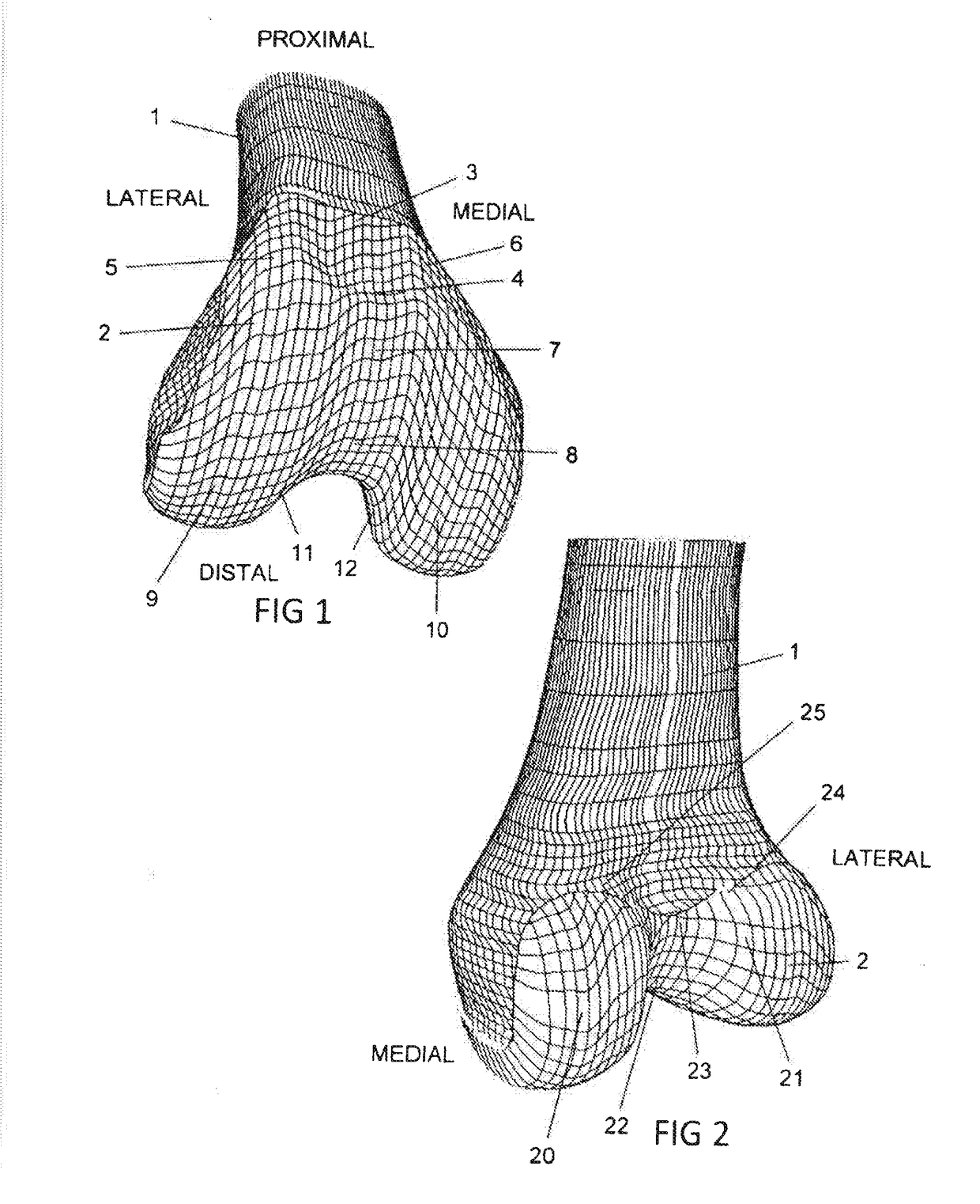 Total knee replacement implant based on normal anatomy and kinematics