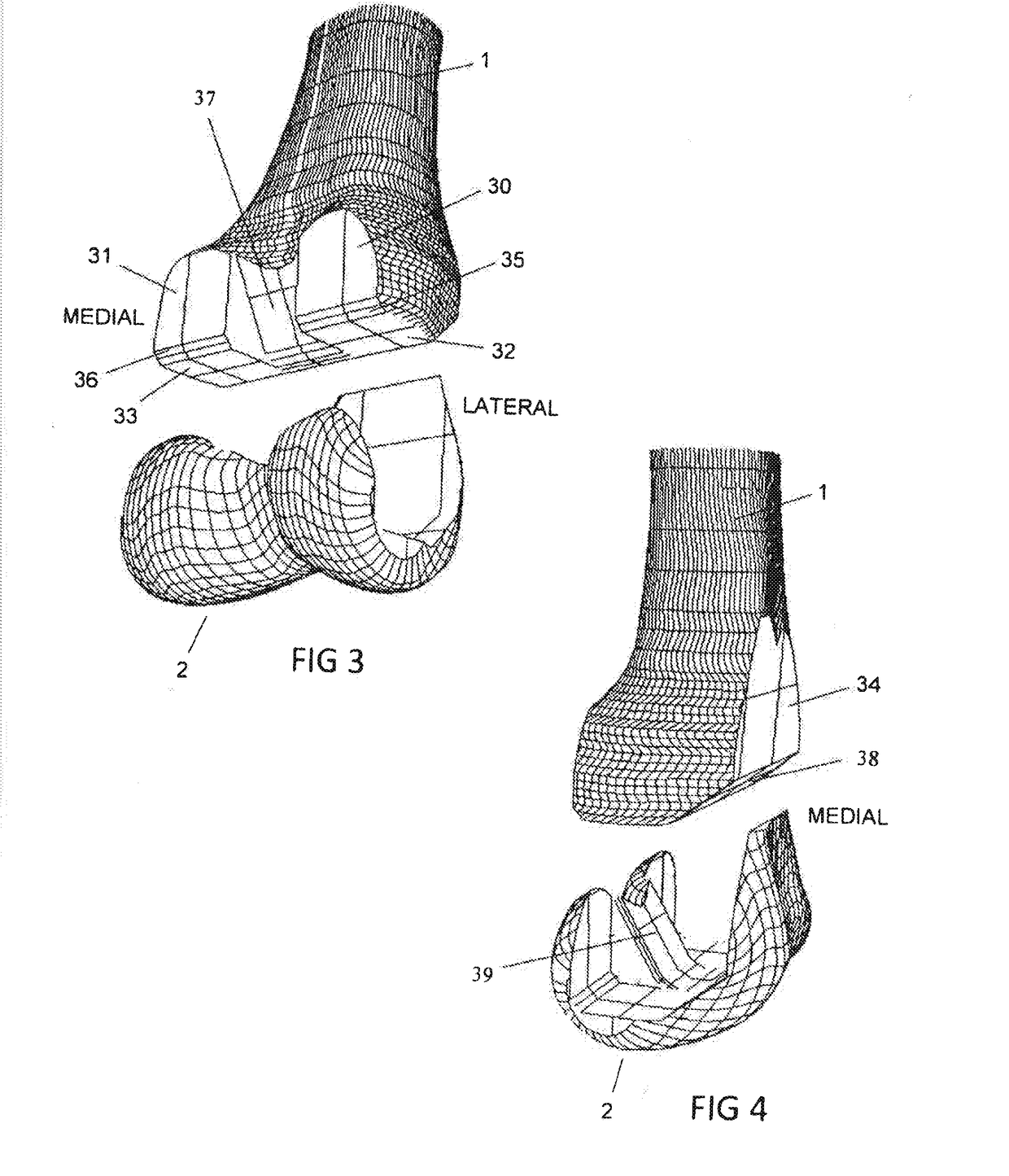 Total knee replacement implant based on normal anatomy and kinematics