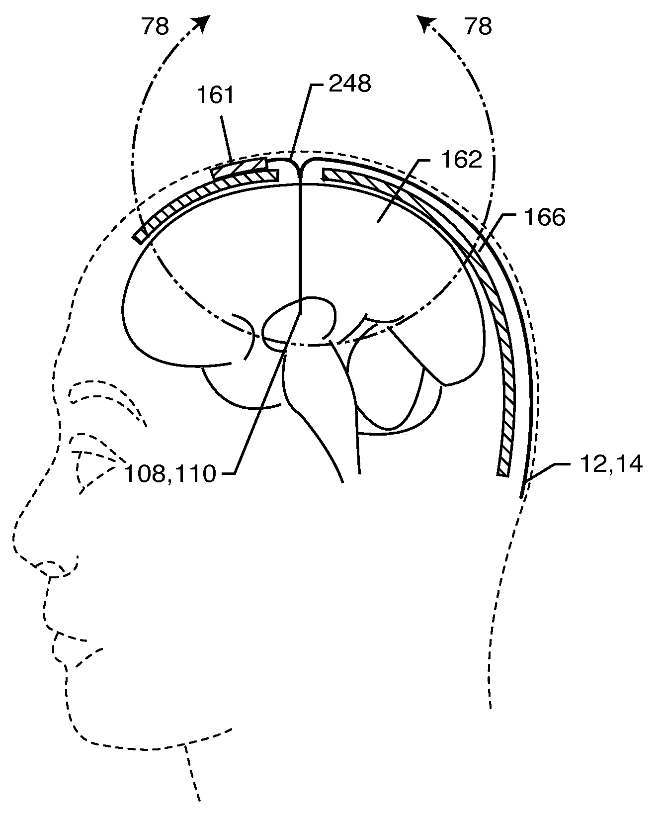 Tuned energy balanced system for minimizing heating and/or to provide EMI protection of implanted leads in a high power electromagnetic field environment