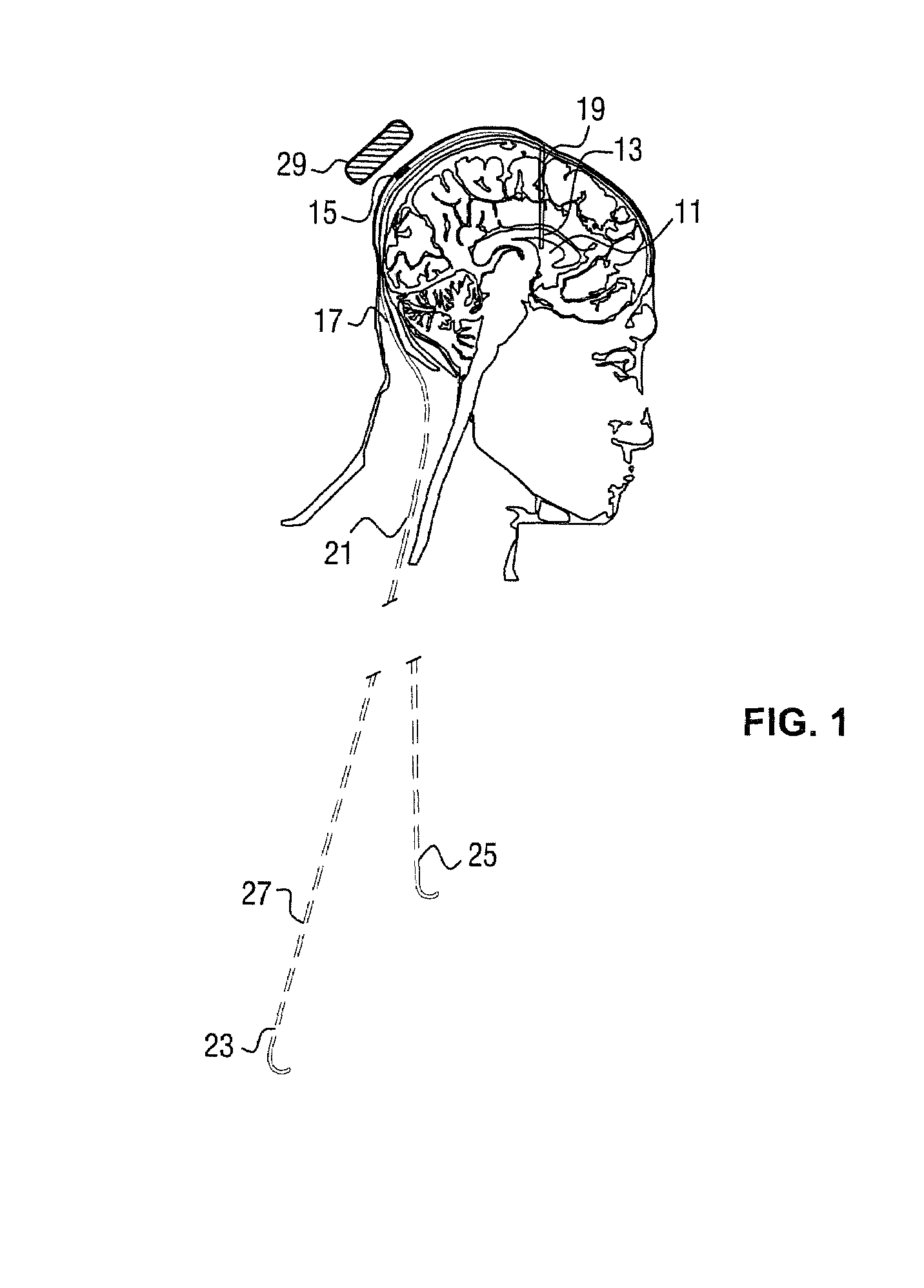 Electroactive polymer actuated cerebrospinal fluid shunt