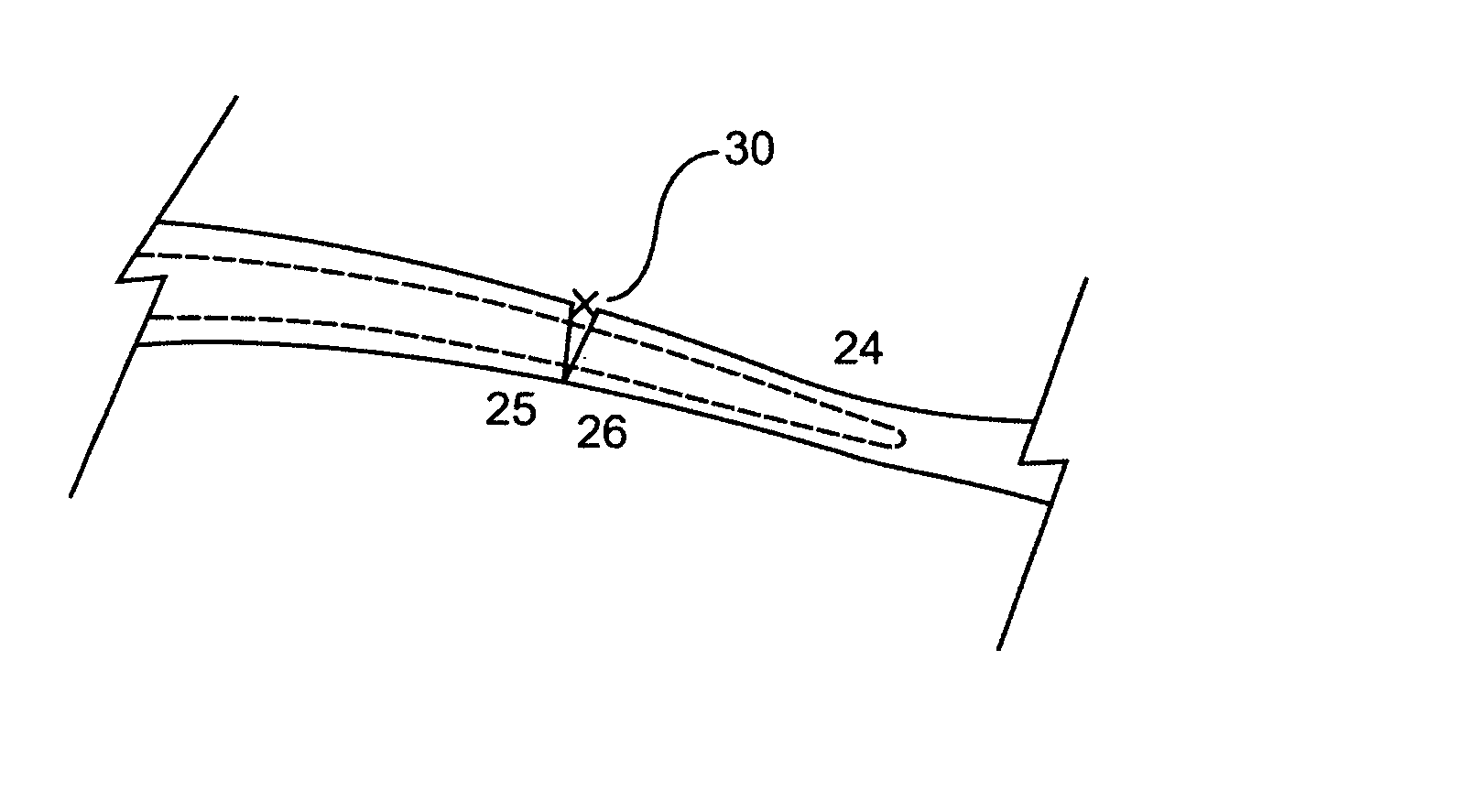 Fallopian tube intra-luminal splint for reanastomosis