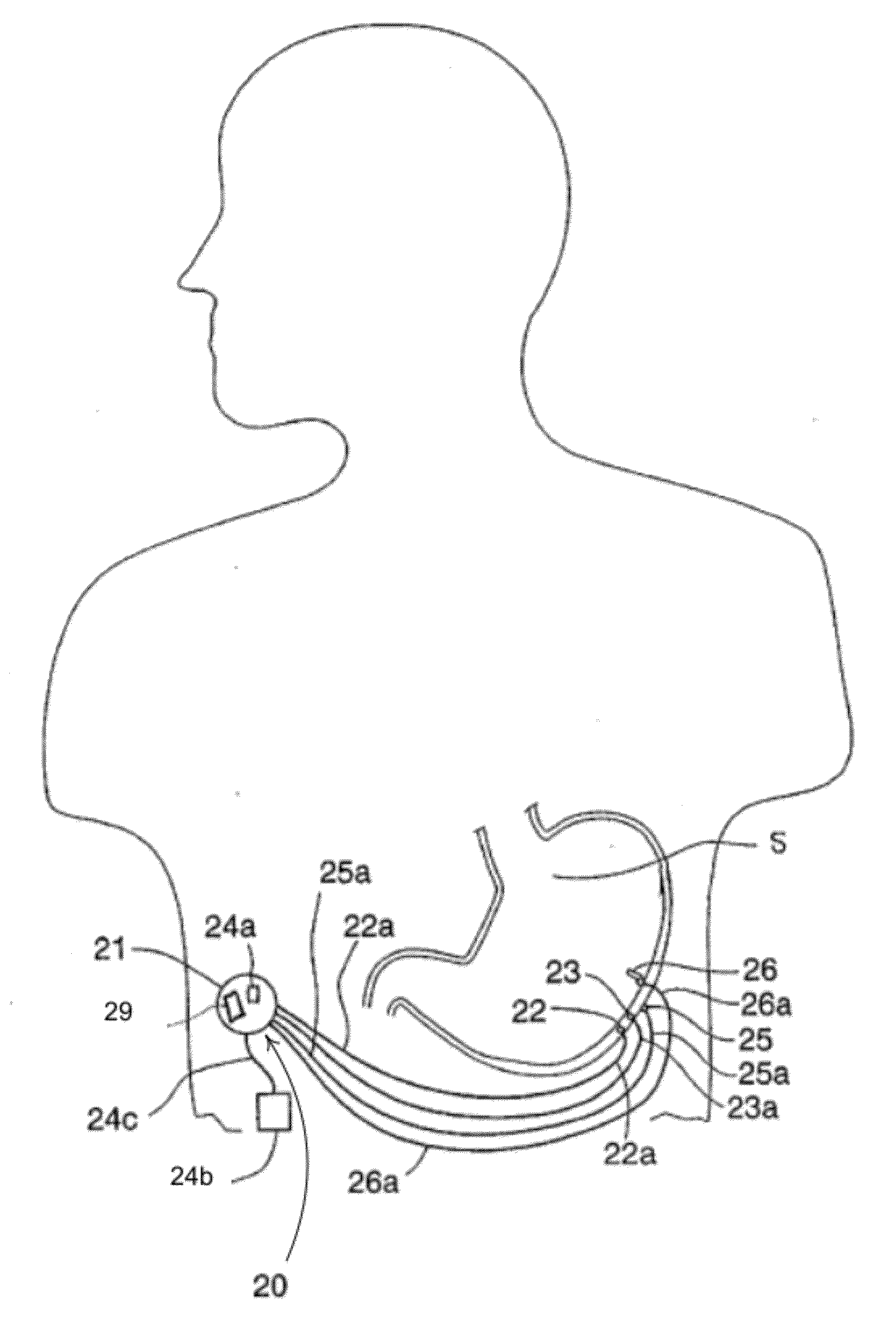 Event Evaluation Using Heart Rate Variation for Ingestion Monitoring and Therapy