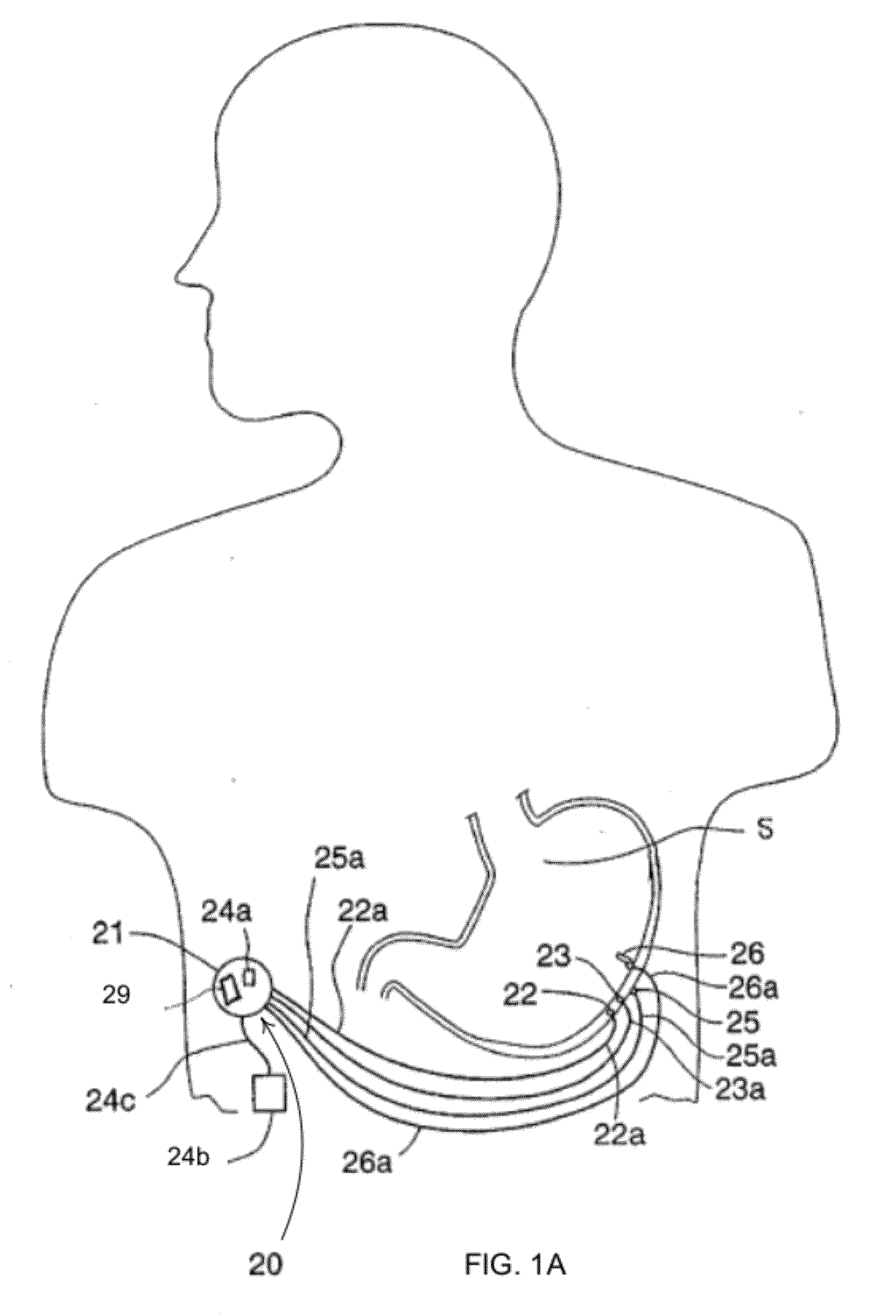 Event Evaluation Using Heart Rate Variation for Ingestion Monitoring and Therapy