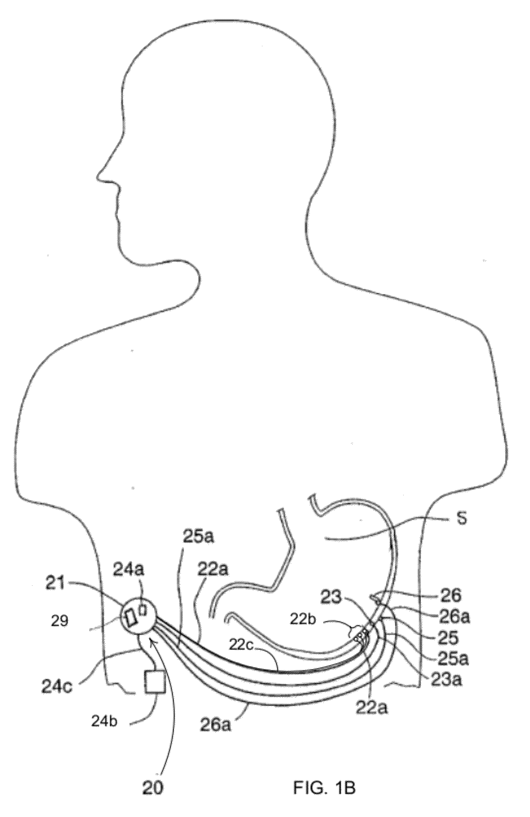 Event Evaluation Using Heart Rate Variation for Ingestion Monitoring and Therapy