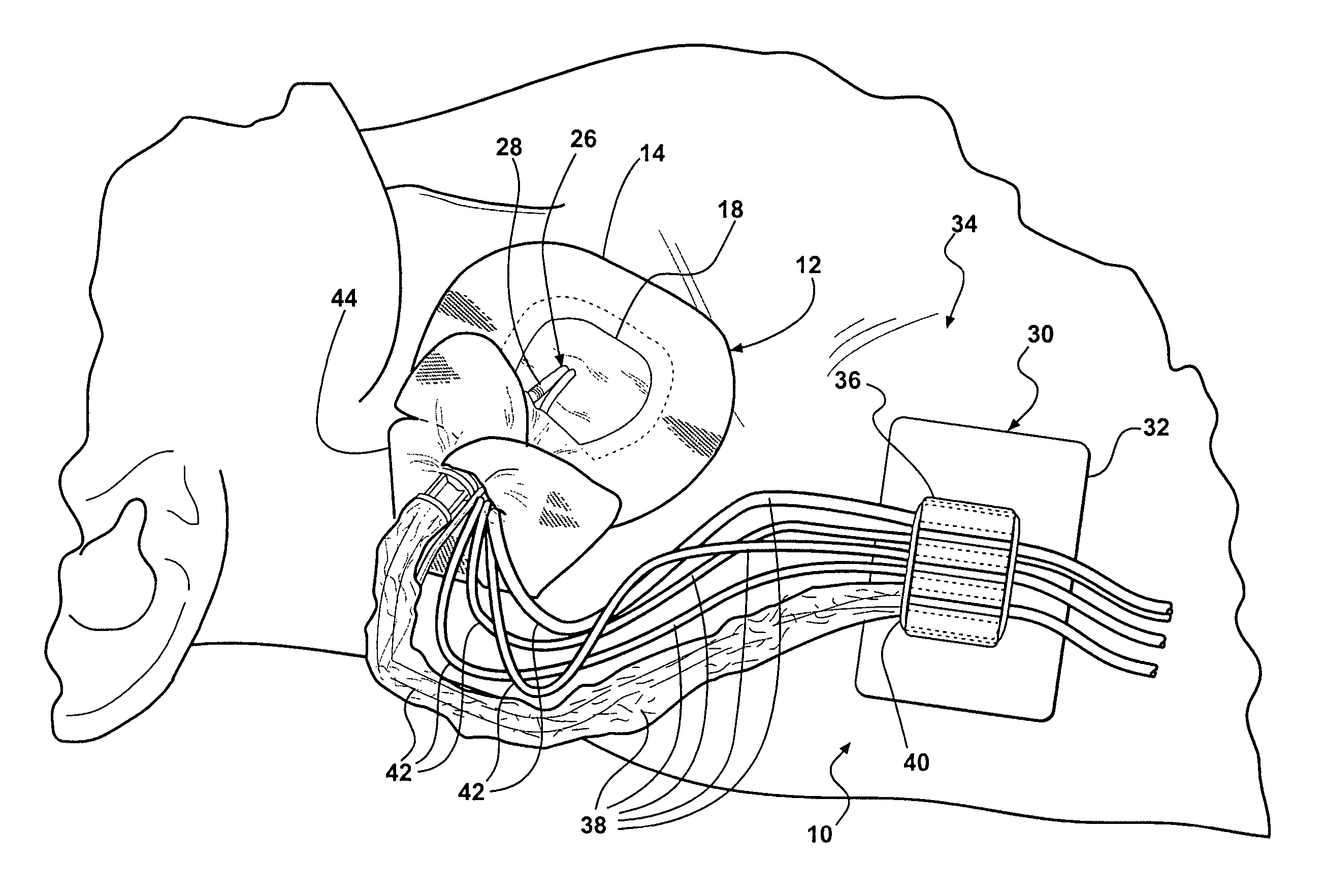 Jugular and subclavian access site dressing, anchoring system and method