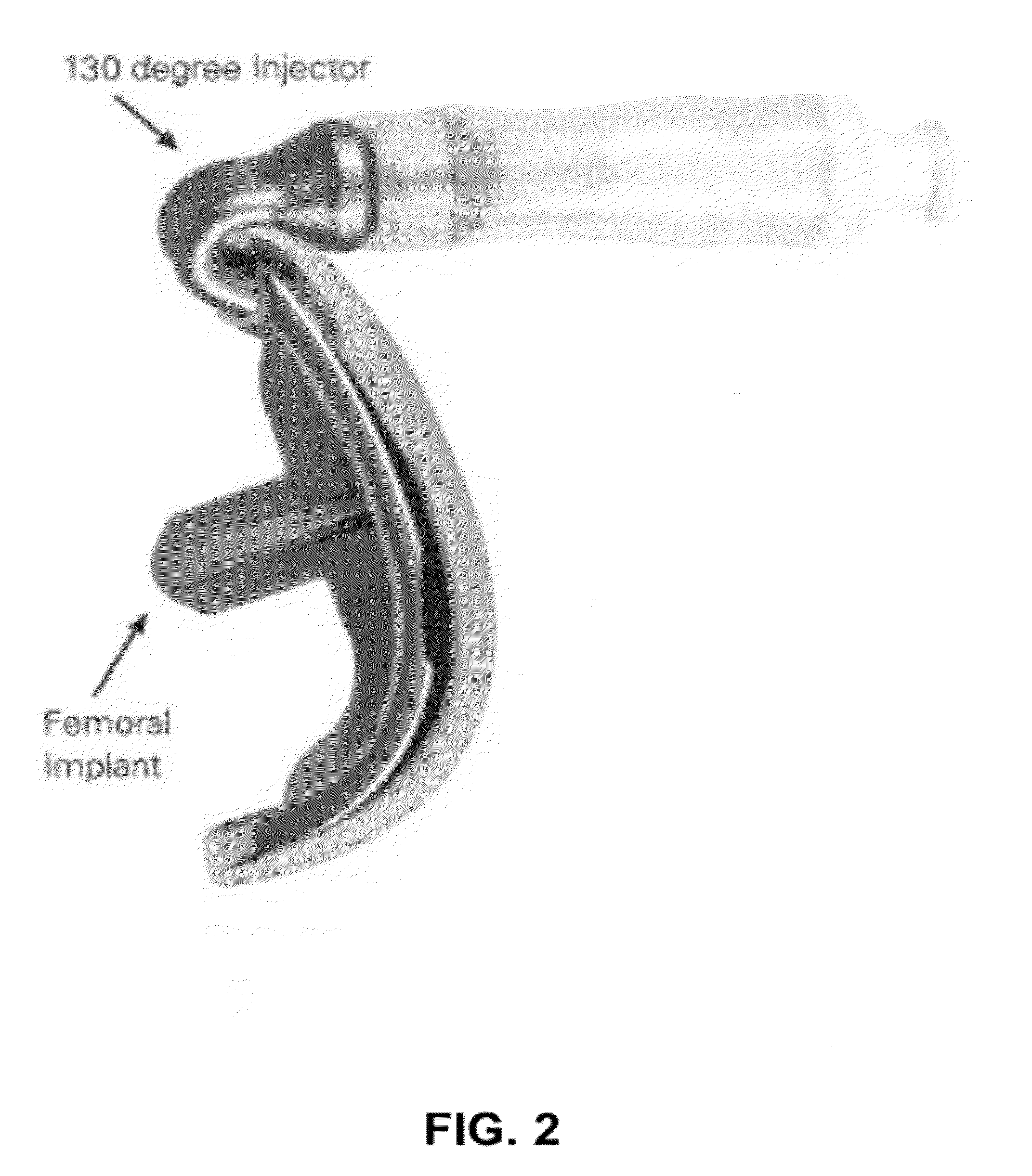 Method of implanting a prosthesis device using bone cement in liquid form