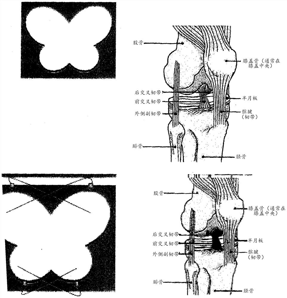 Sutureless Repair of Soft Tissue