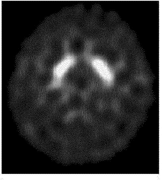 Semi-automatic quantification method based on development specificity extraction ratio of dopamine transporter