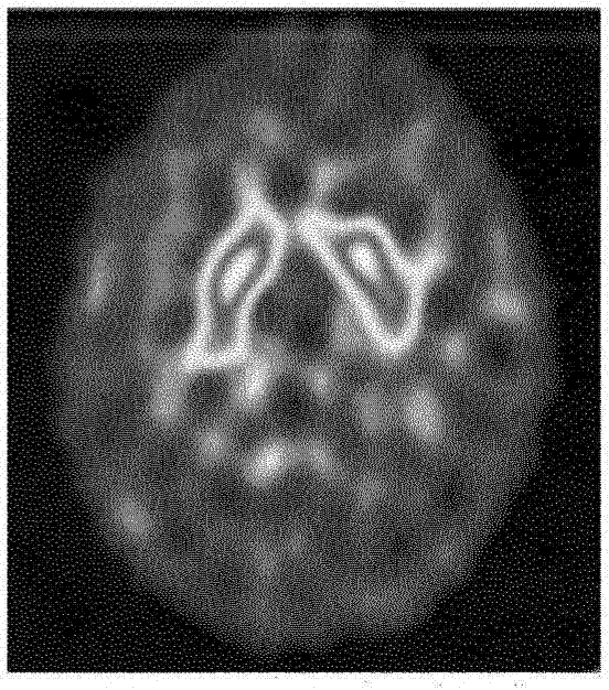 Semi-automatic quantification method based on development specificity extraction ratio of dopamine transporter