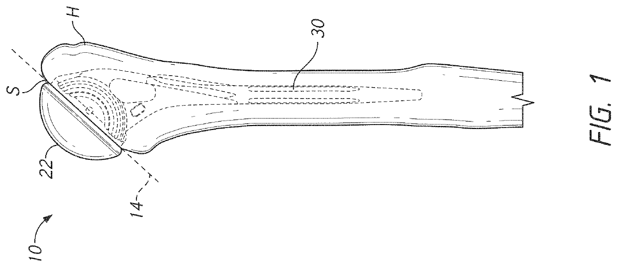 Modular humeral head