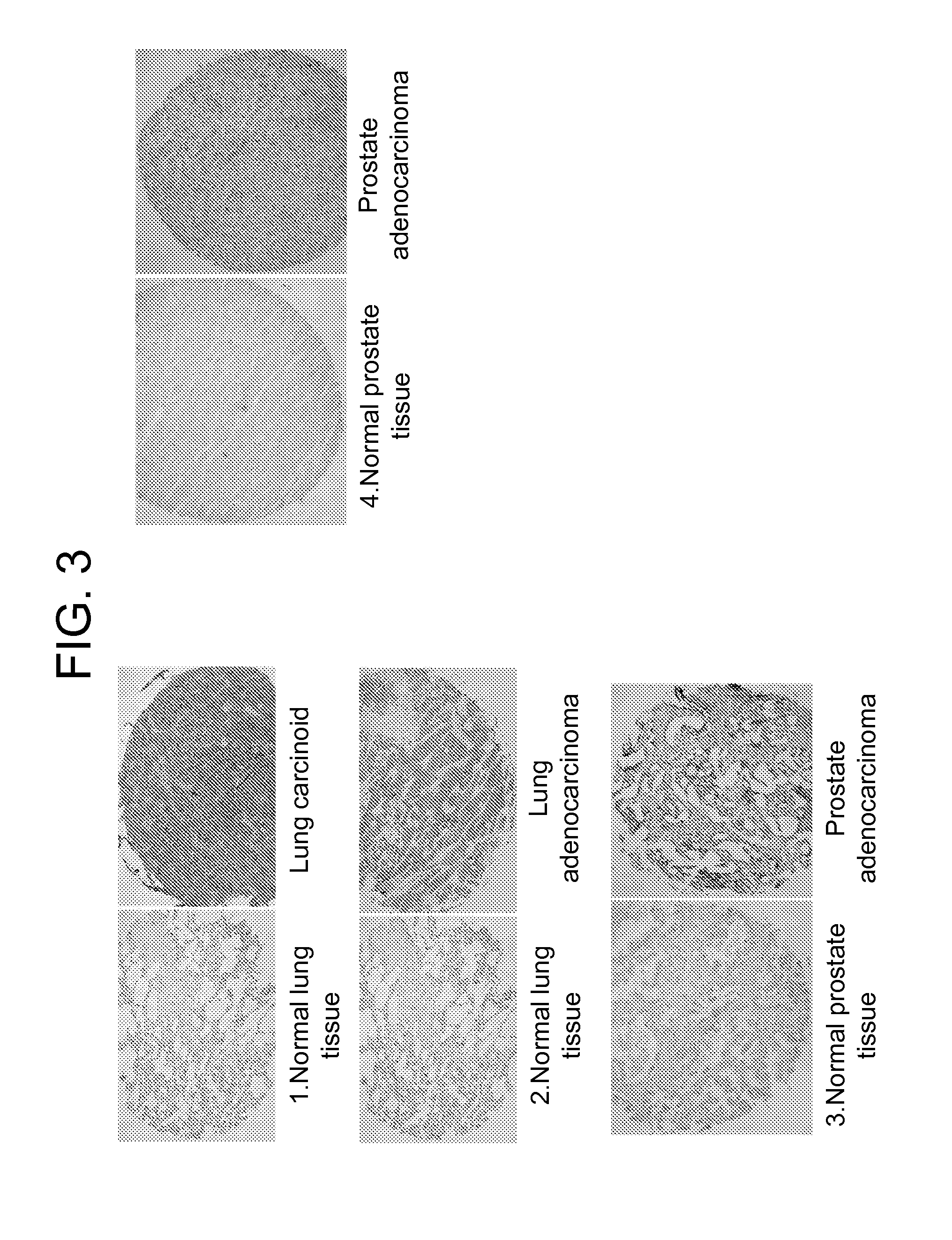 Lambodies with high affinity and selectivity for glycans and uses therefor