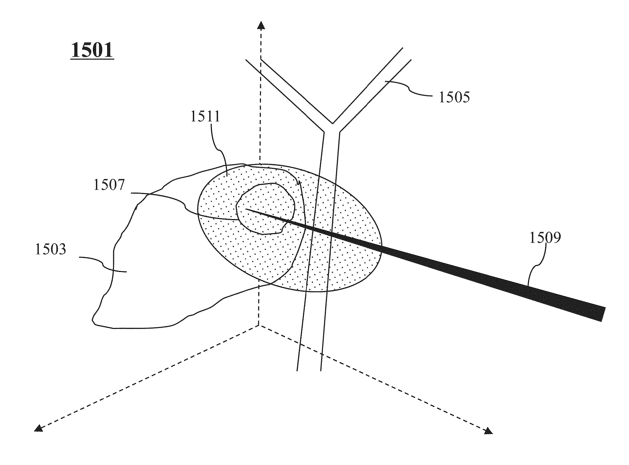 Method and system for adjusting interactive 3D treatment zone for percutaneous treatment