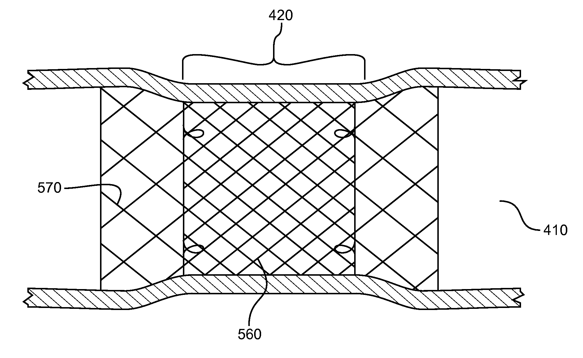 Stent-within-stent arrangements